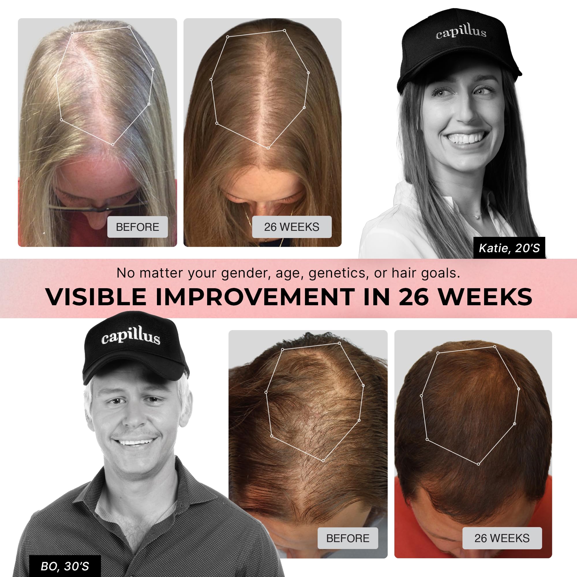 Capillus PRO Red Light Cap for Hair Regrowth — 272 Lasers, FDA Cleared, Bluetooth