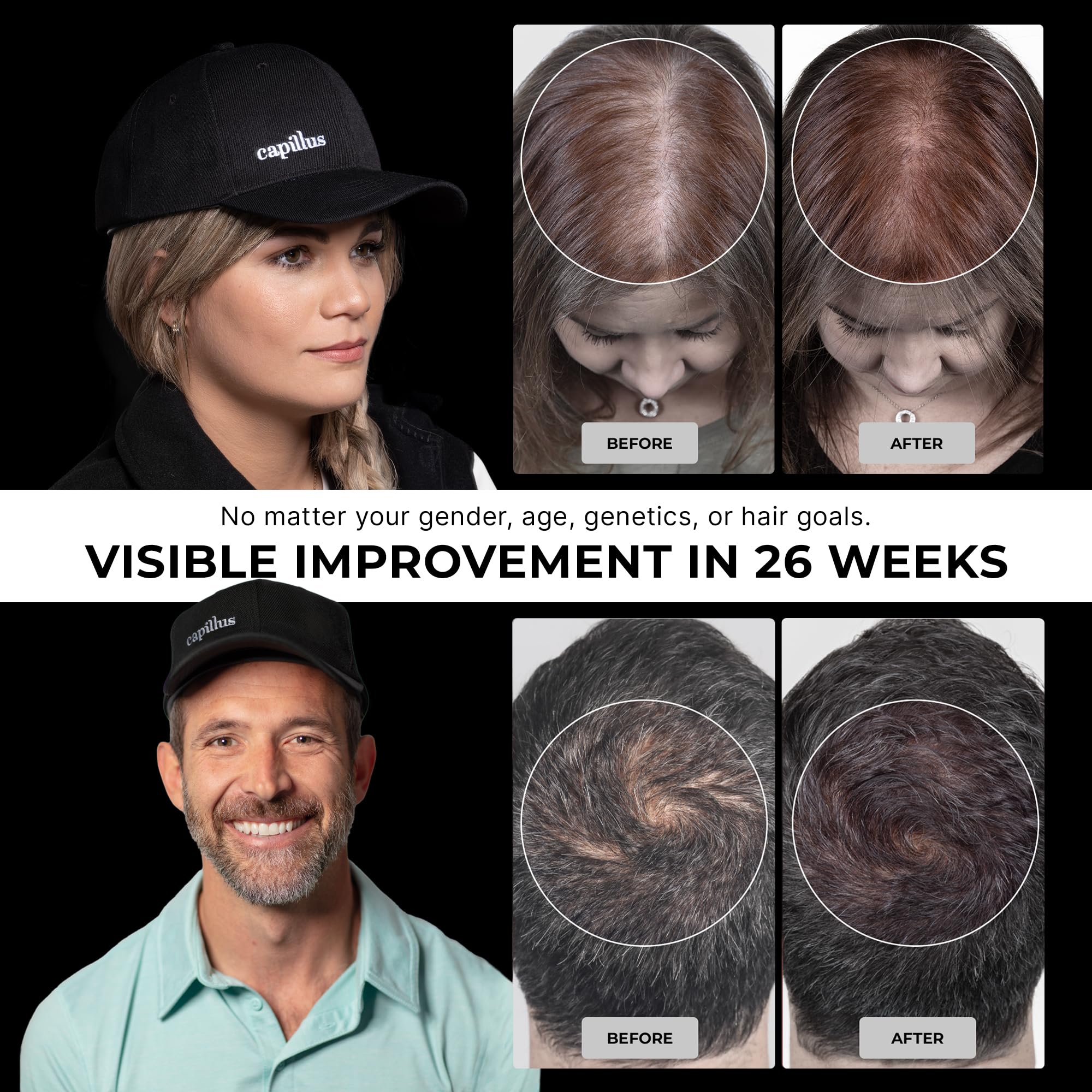 Capillus Pro S2 Red Light Cap for Hair Regrowth | 308 Laser LLLT Hat