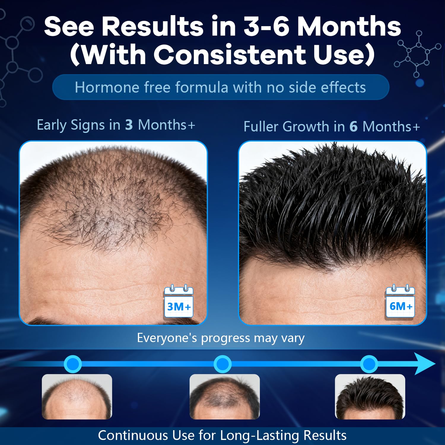 CARENICE 5% Minoxidil Foam for Men with Biotin – Unscented, 8.44oz