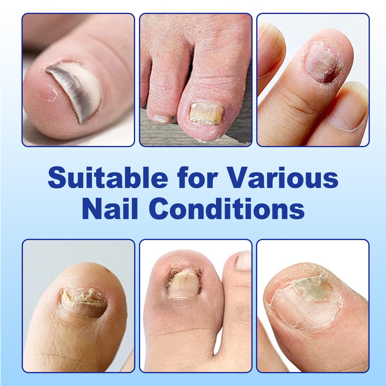 CauseYouLove Nail Patches for Toenails - 2-Pack, 8-Hour Overnight Care, 42 Count