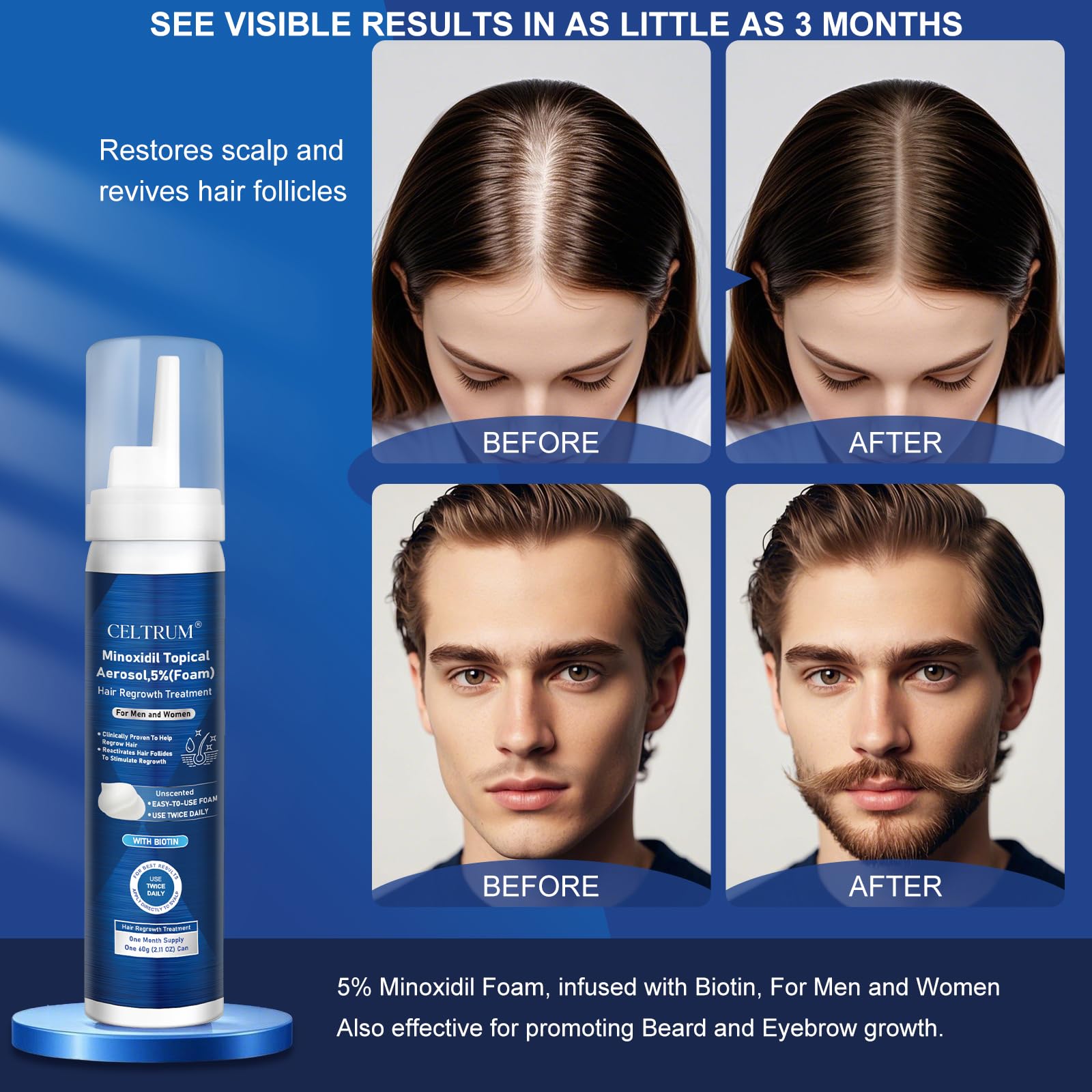 Celtrum 5% Minoxidil Foam for Men & Women — 8.44 oz (4-Month Supply) with Biotin