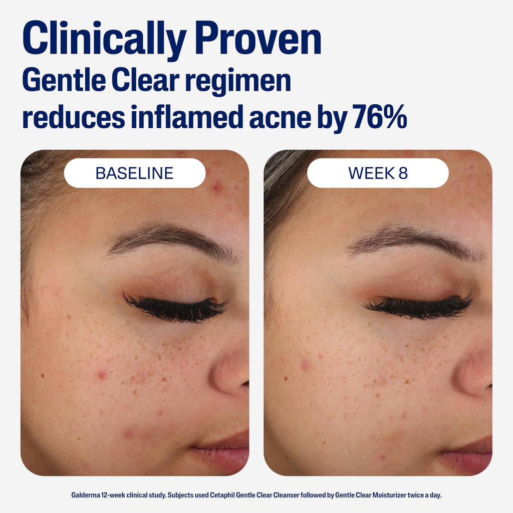 Cetaphil Mattifying Acne Moisturizer with 0.5% Salicylic Acid – Gentle Hydration for Sensitive, Acne-Prone Skin | 3oz