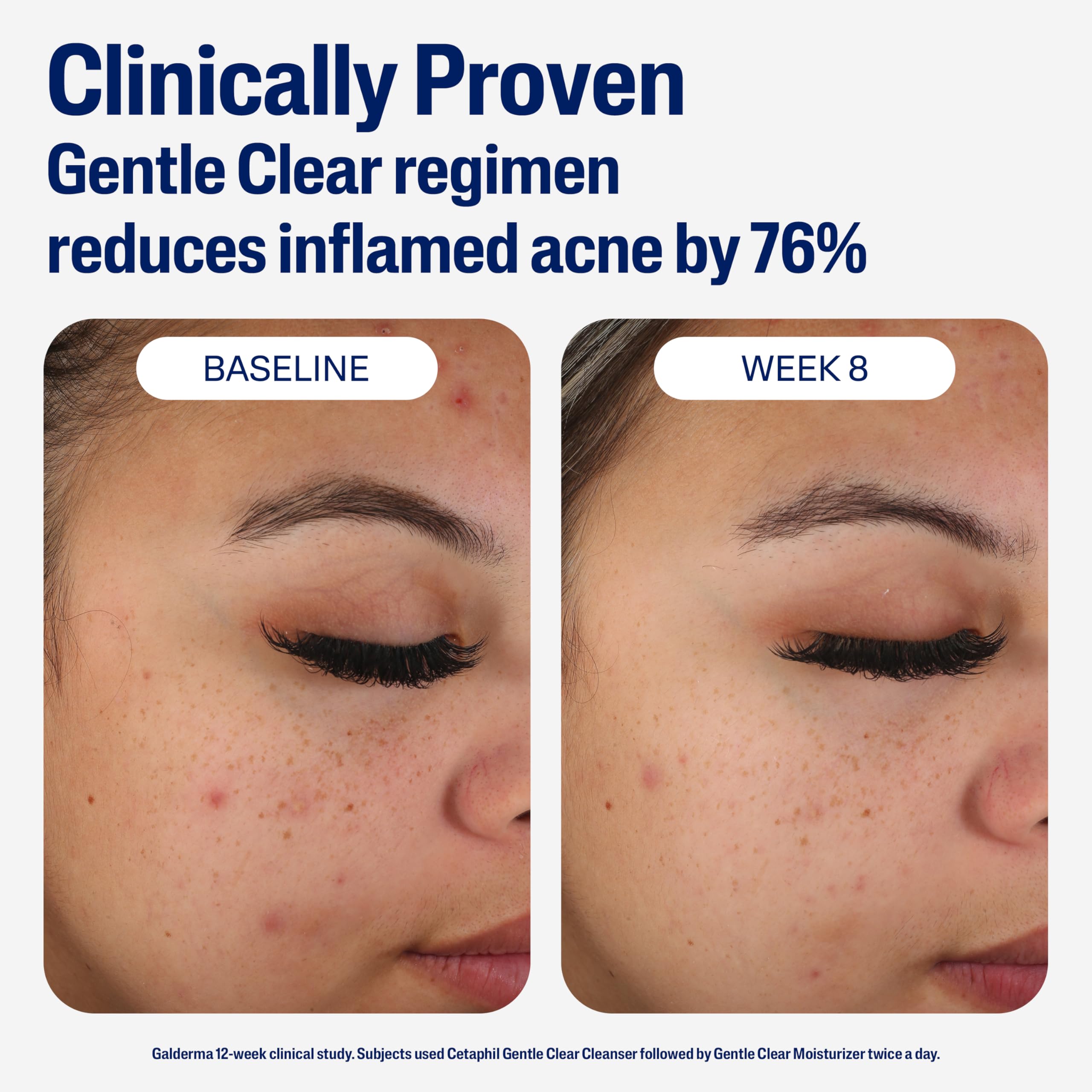 Cetaphil Mattifying Acne Moisturizer with 0.5% Salicylic Acid – Gentle Hydration for Sensitive, Acne-Prone Skin | 3oz