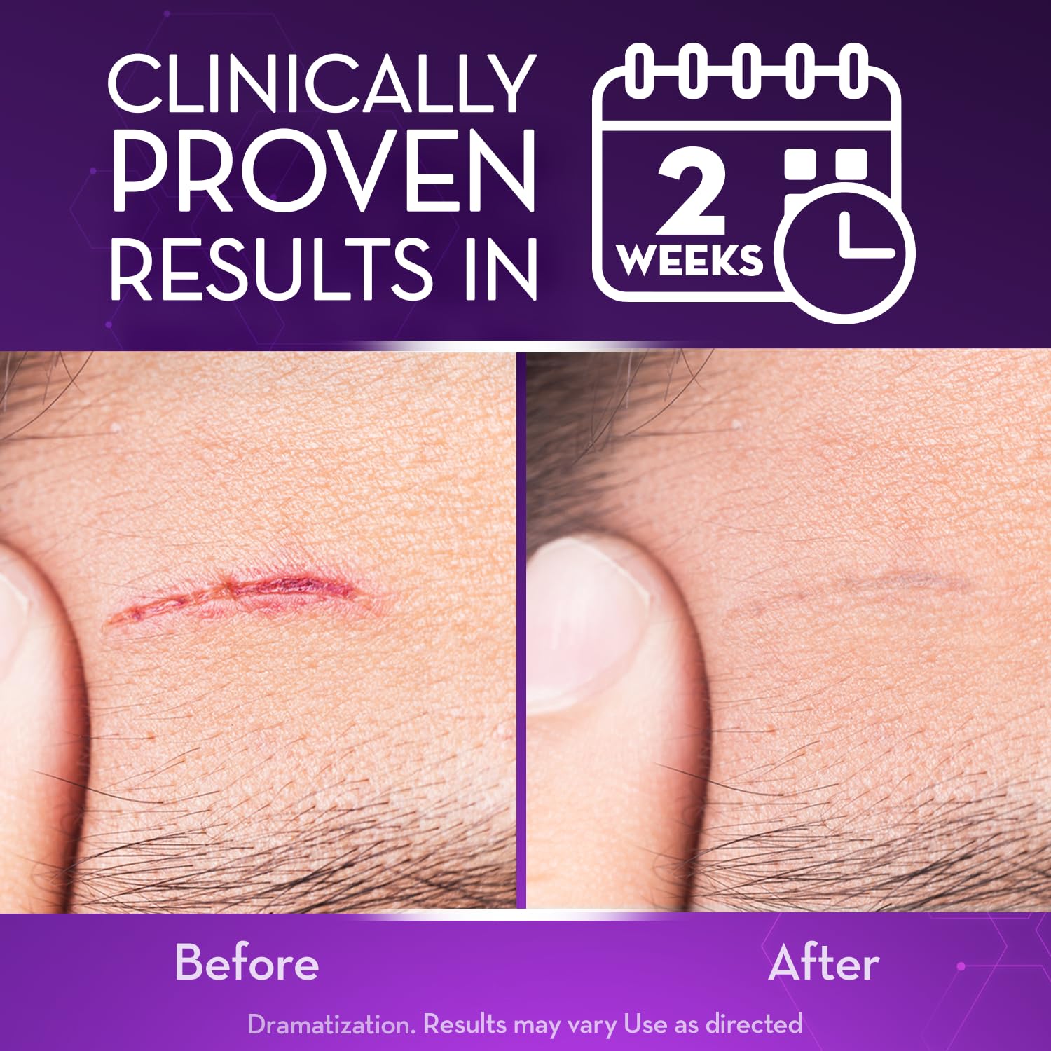 Cicatricure Advanced Scar Gel for Face & Body – Clinically Proven Results in 2 Weeks
