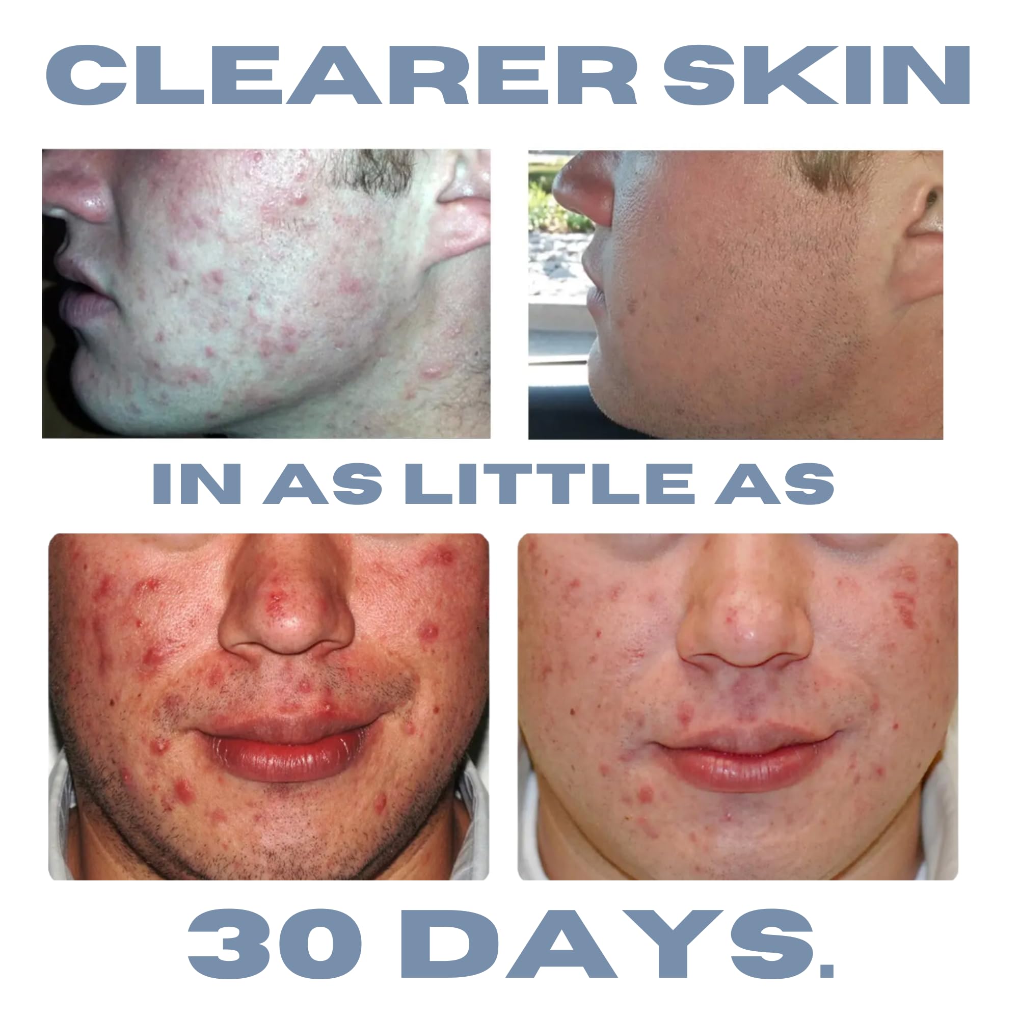 Clearogen Sensitive Skin Sulfur Acne Lotion - Acne Treatment 1.8 oz