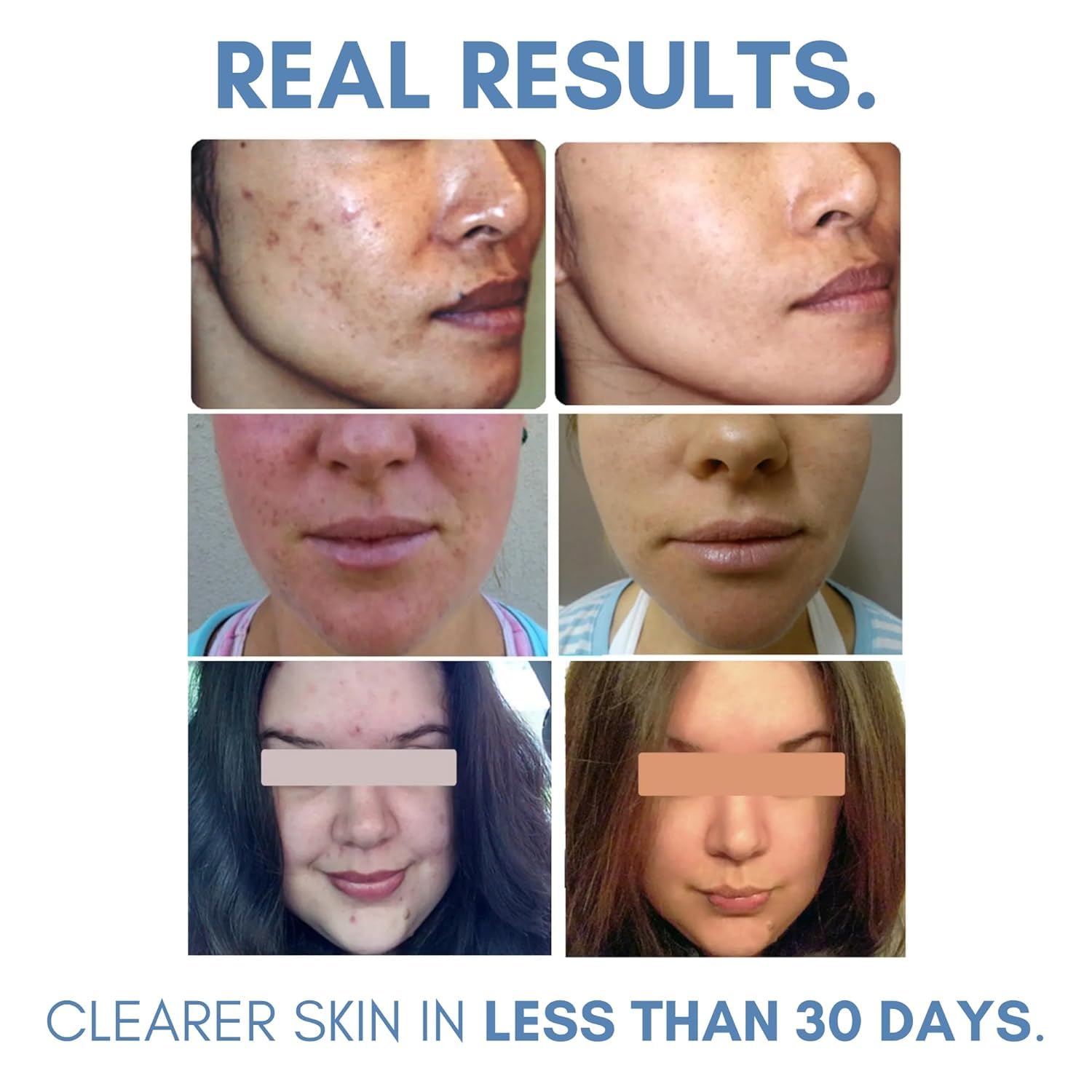 Clearogen Sensitive Skin Sulfur Acne Lotion - Acne Treatment 1.8 oz