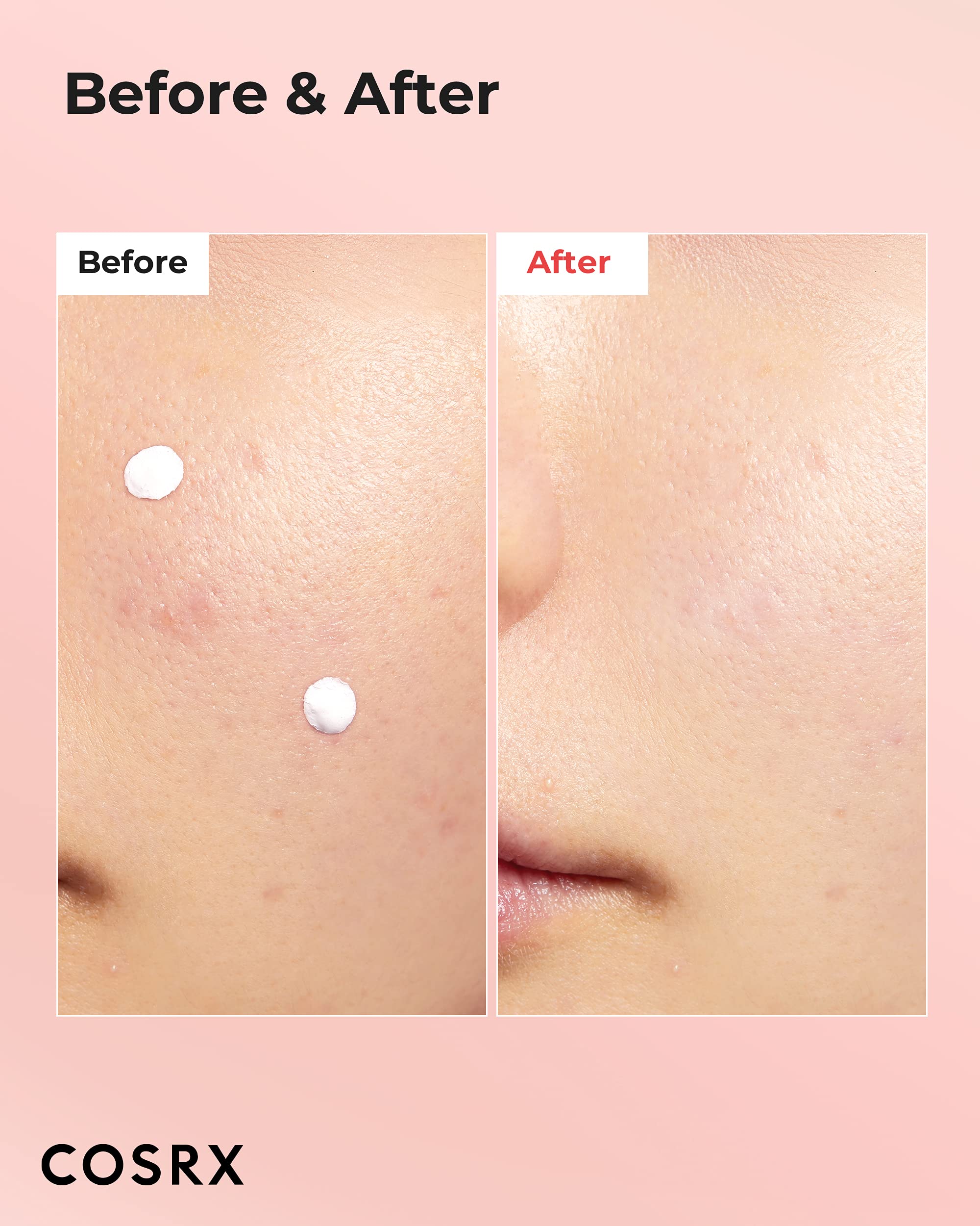 COSRX Acne Blemish Spot Drying Lotion 1.01 fl oz / 30 ml – Targeted Spot Treatment for Blemishes