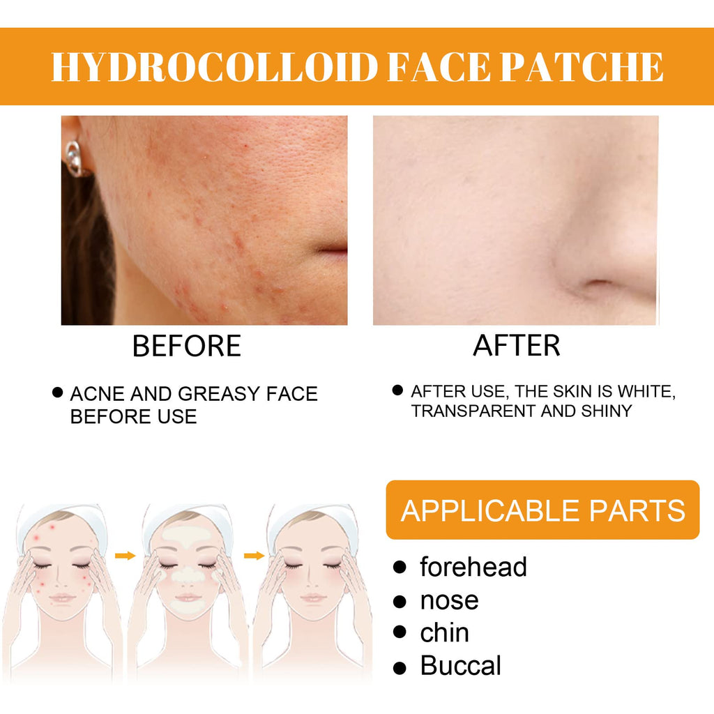 Coweroay 20PCS Hydrocolloid Acne Patches – Full-Face Spot Coverage
