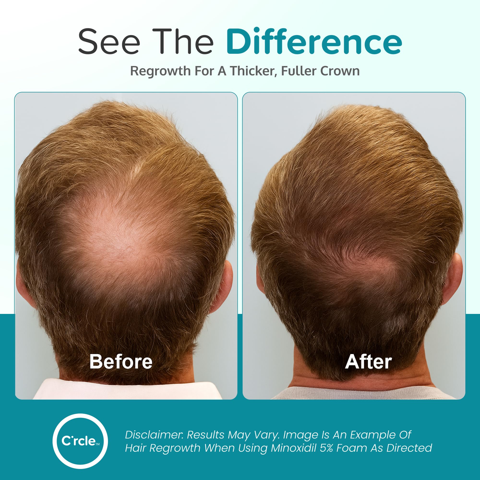 C'rcle Minoxidil for Men Foam 5% - Unscented, 6-Month Supply