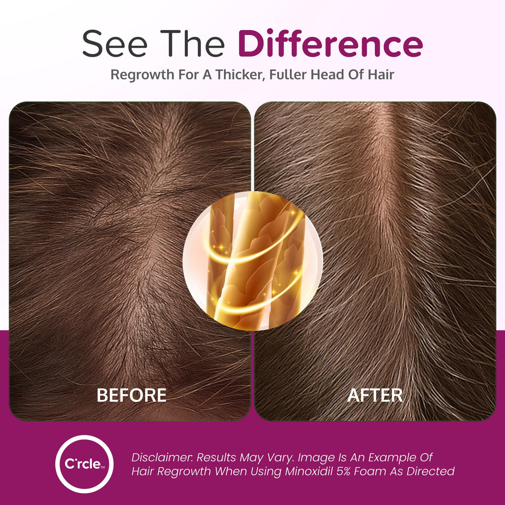 C'rcle Minoxidil 5% Foam for Women – Hair Regrowth & Thinning Hair Solution (4-Month Supply)