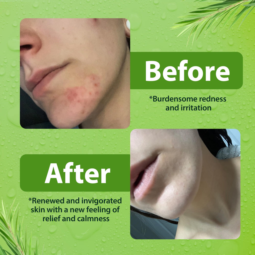 Derma-Nu Antibacterial Body Wash | Tea Tree, Jock Itch & Athlete's Foot Care, 8 oz