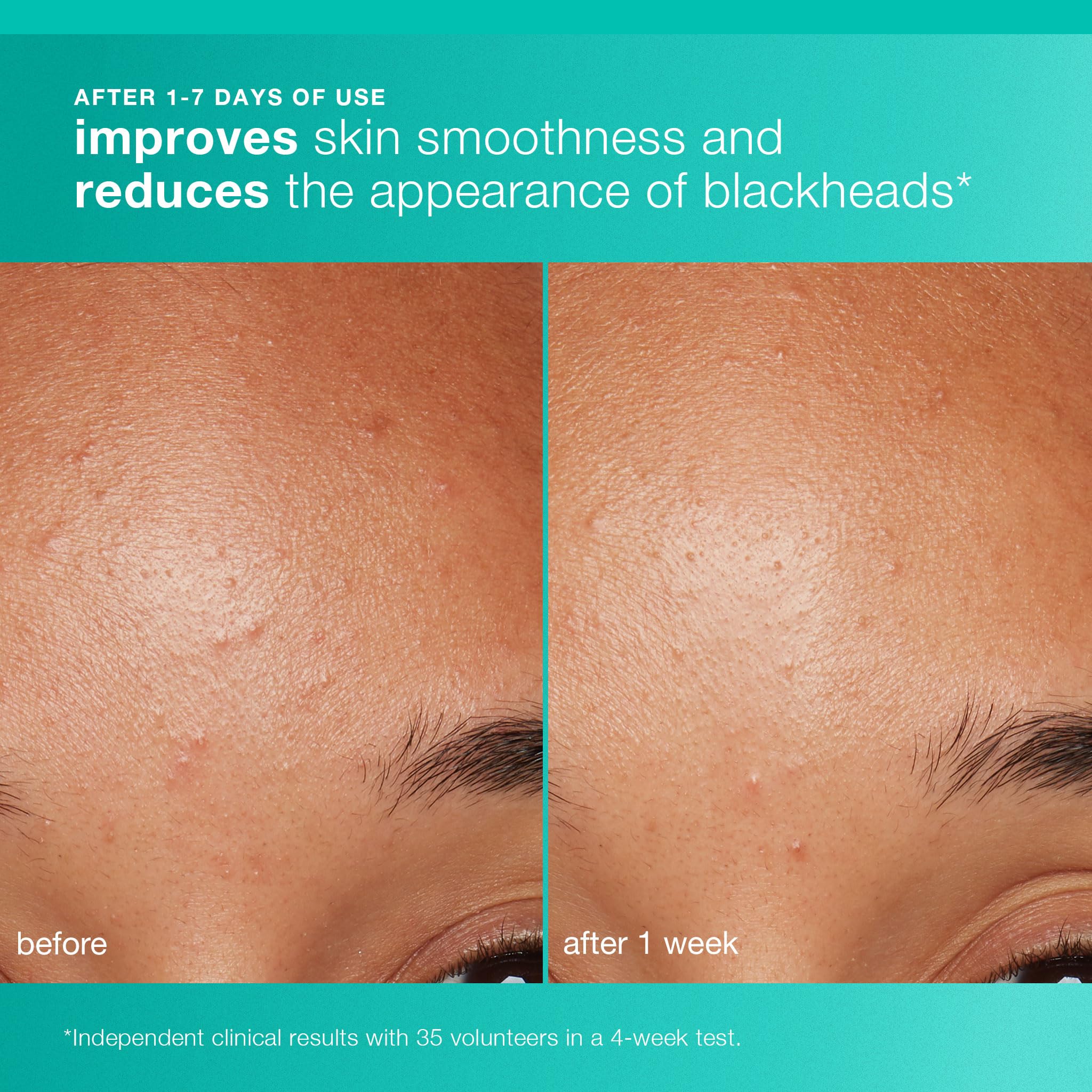 Dermalogica Clear and Brighten Kit – 3 Step Acne & Brightening Skincare Set