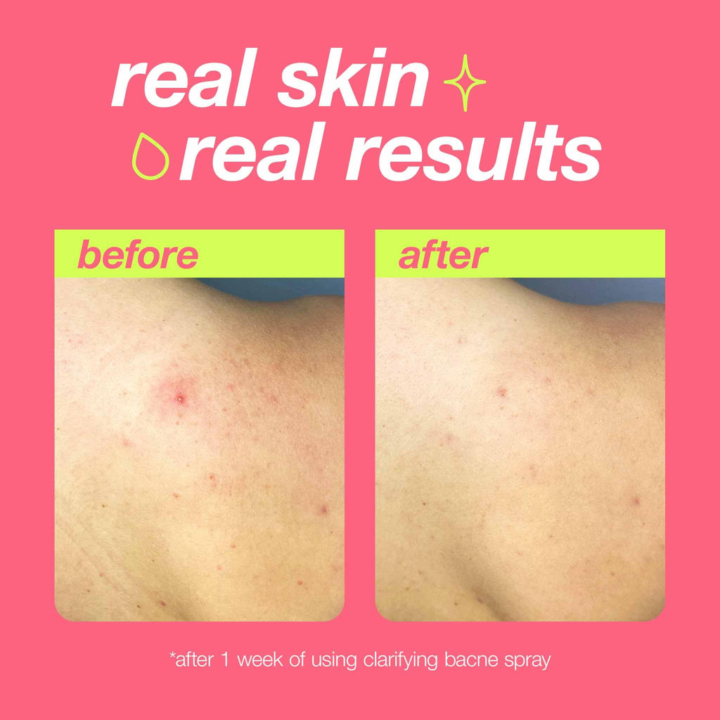 Dermalogica Clear Start Bacne Spray – Back Acne Treatment with Salicylic Acid