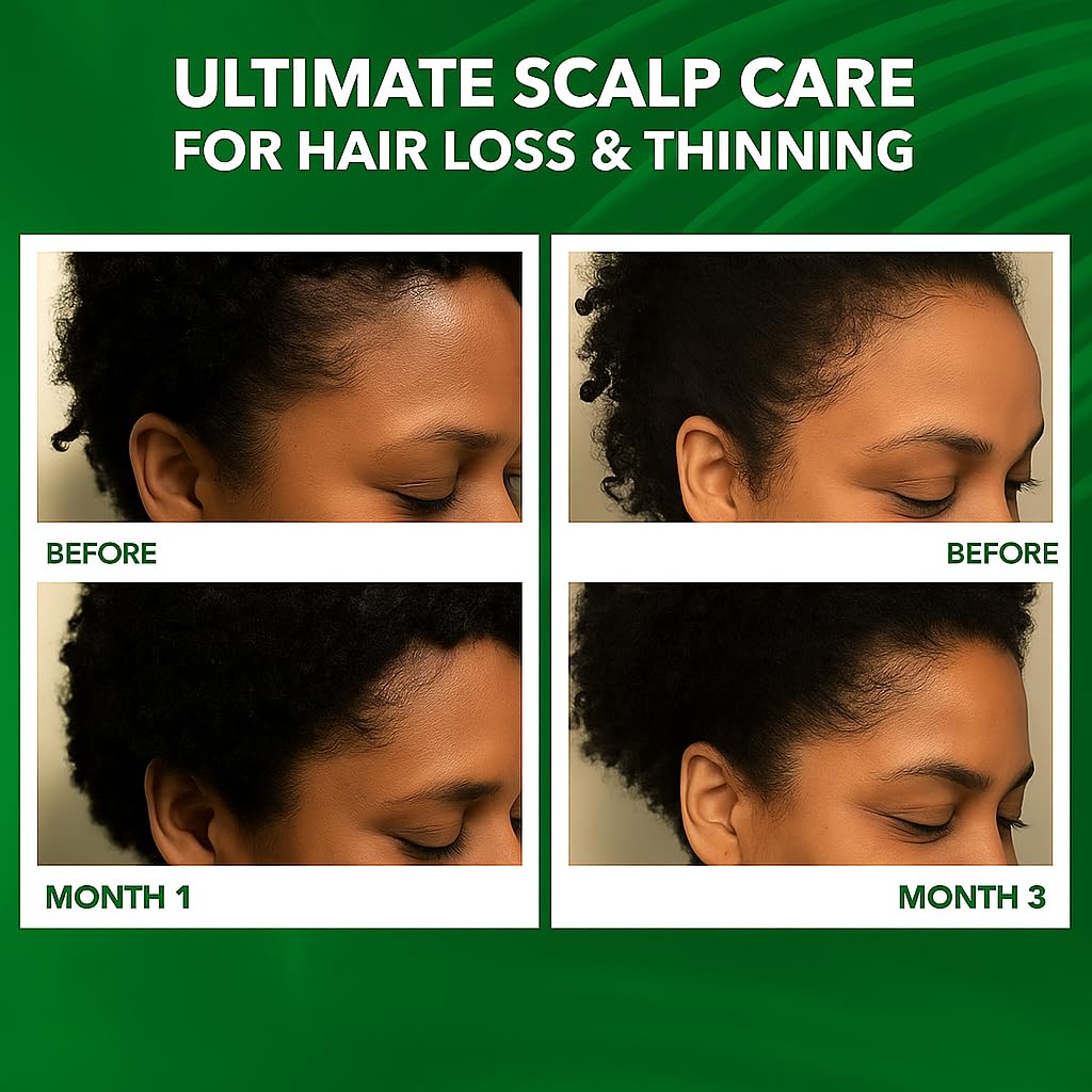 Dersie Scalp Oil for Hair Loss & Thinning Hair – Batana, Rosemary & Tea Tree (60mL)