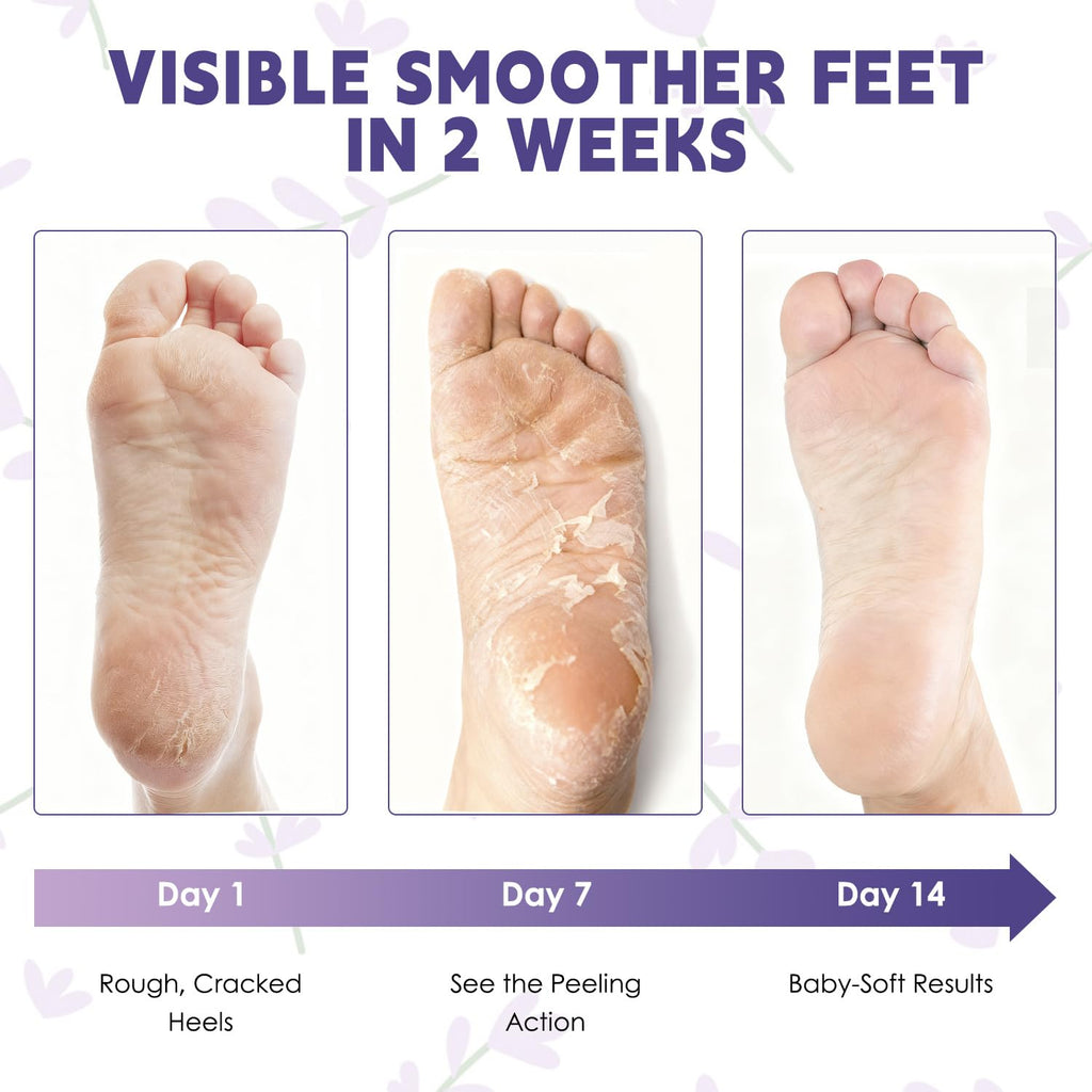 Devyonder Foot Peeling Mask 5 Pack – Exfoliate, Soften & Rejuvenate Dry Heels (Urea, Lavender & Salicylic Acid)