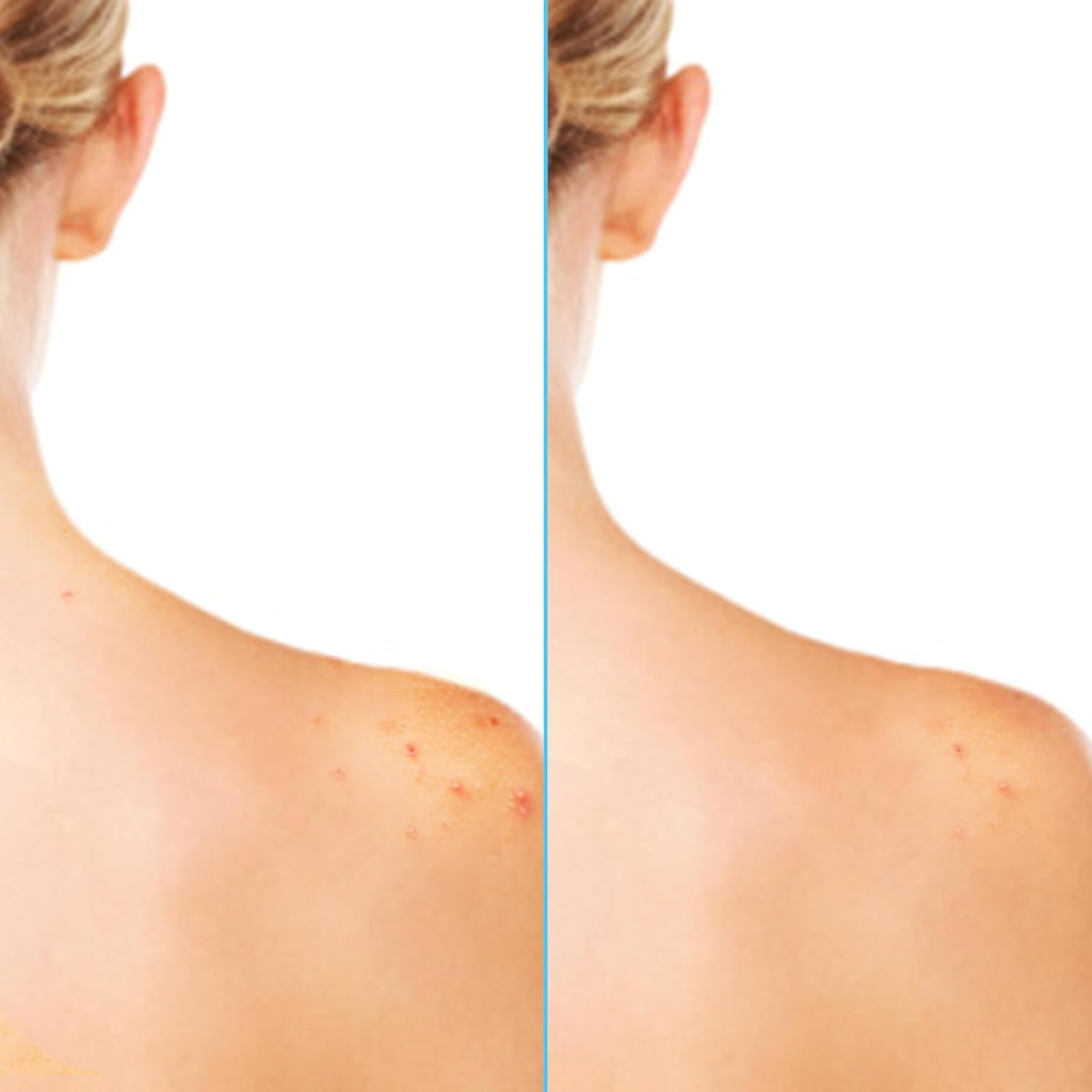 Differin Acne-Clearing Body Spray with Salicylic Acid – 2% SA, 360° Mist, 6 oz