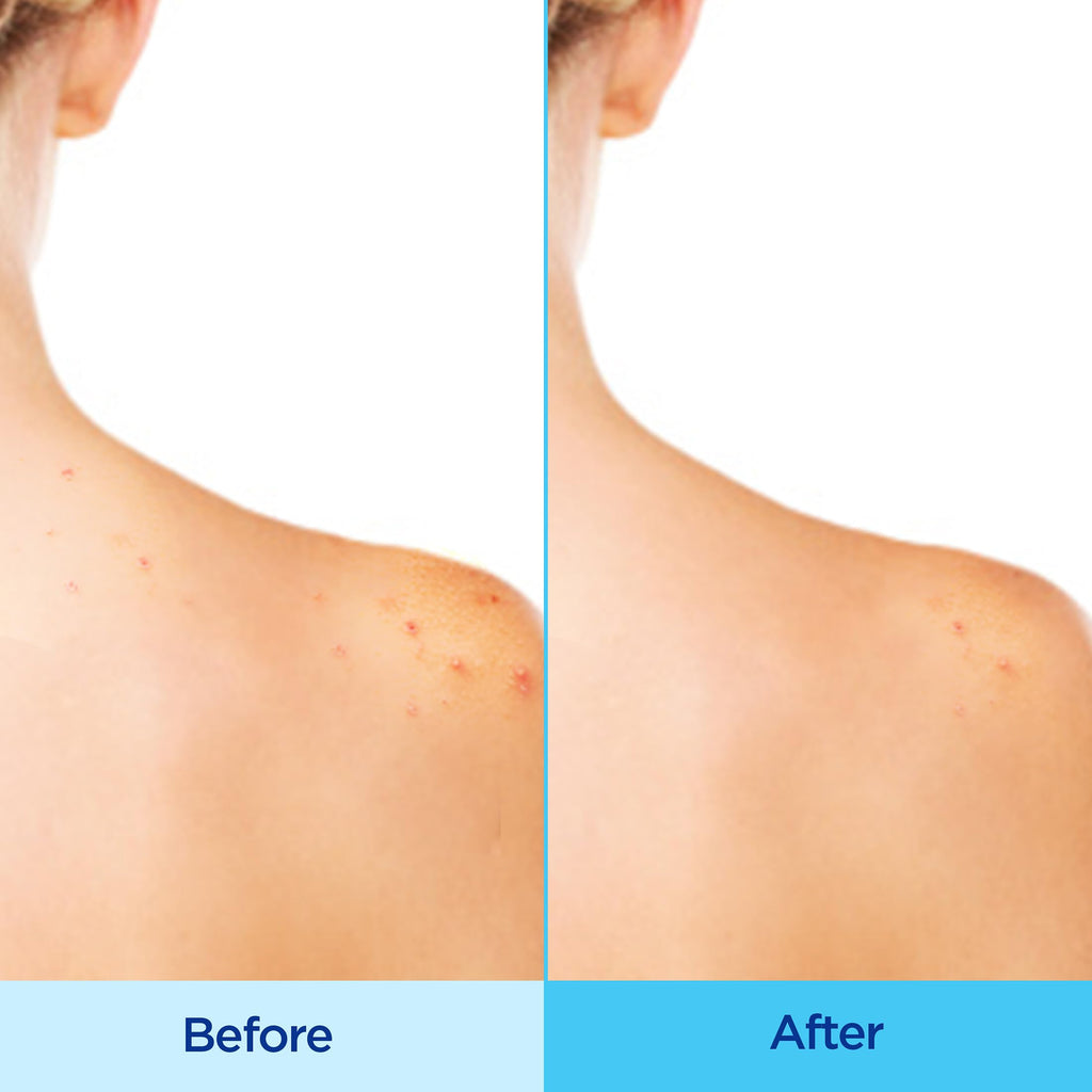 Differin Acne-Clearing Body Spray with Salicylic Acid – 2% SA, 360° Mist, 6 oz