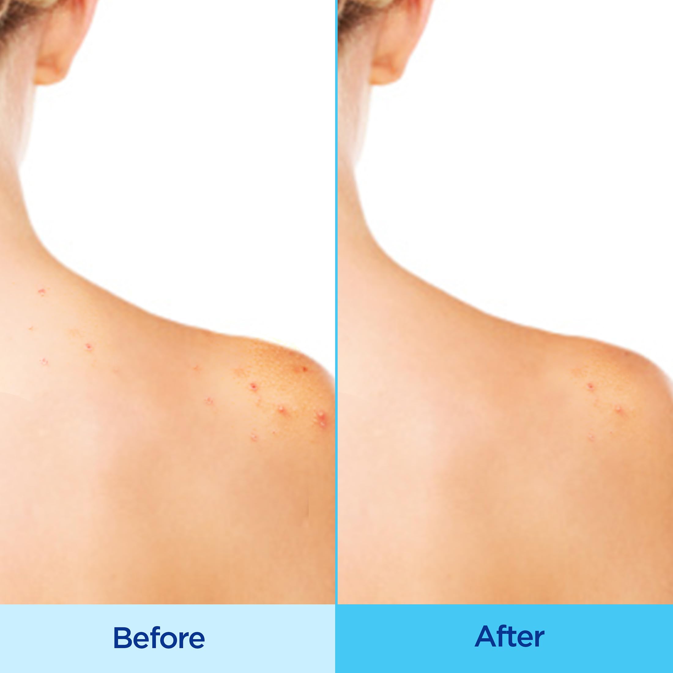 Differin Acne-Clearing Body Spray with Salicylic Acid – 2% SA, 360° Mist, 6 oz
