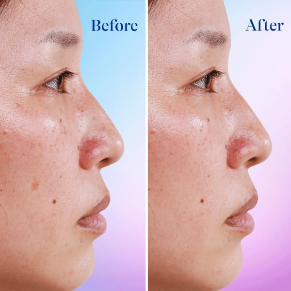 Differin Dark Spot Correcting Serum — 4% Niacinamide for Acne-Prone Skin