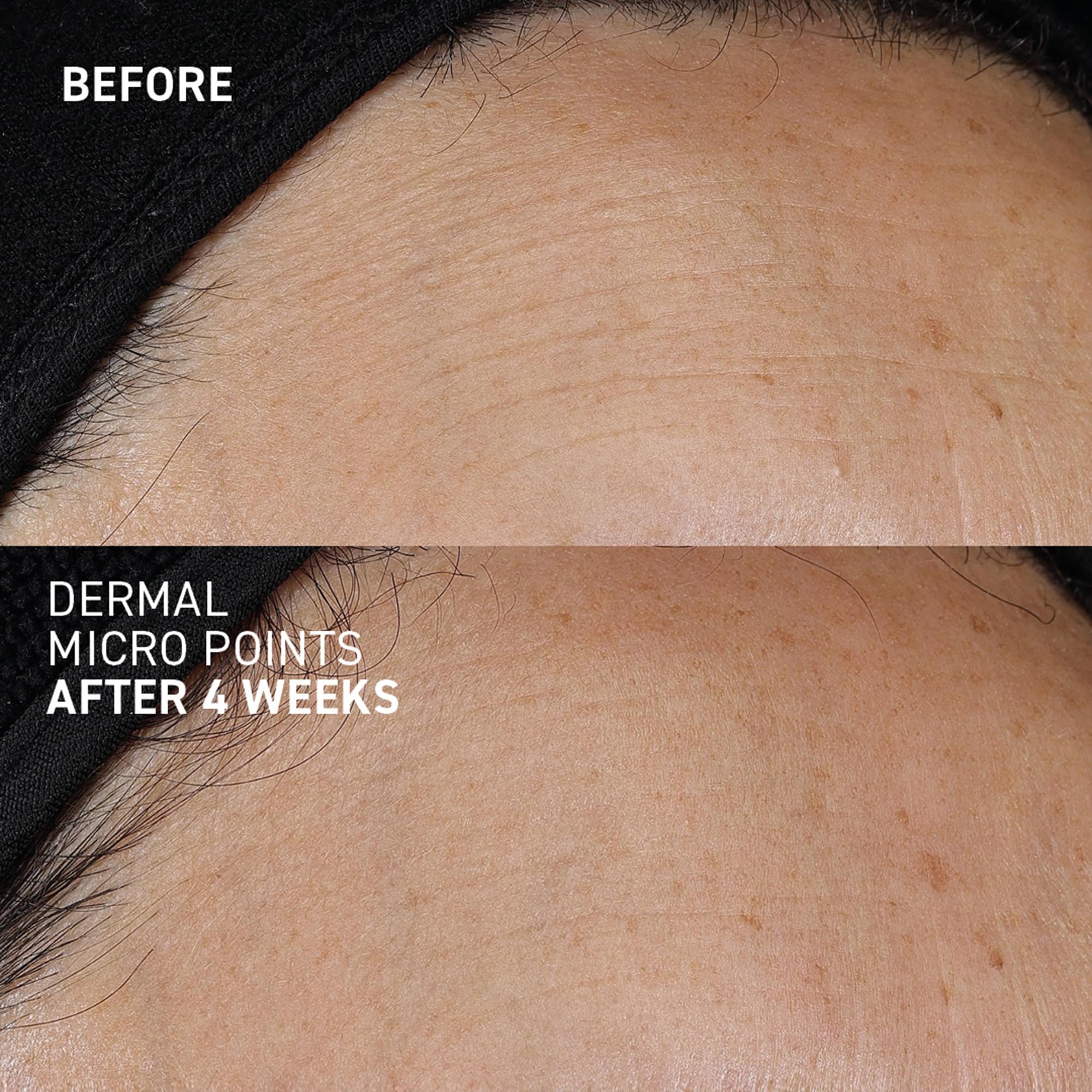 Dr. Brandt Needles No More Dermal Micro Points – Intensive Skin-Lifting Gel for Texture & Fine Lines | 1.0 oz