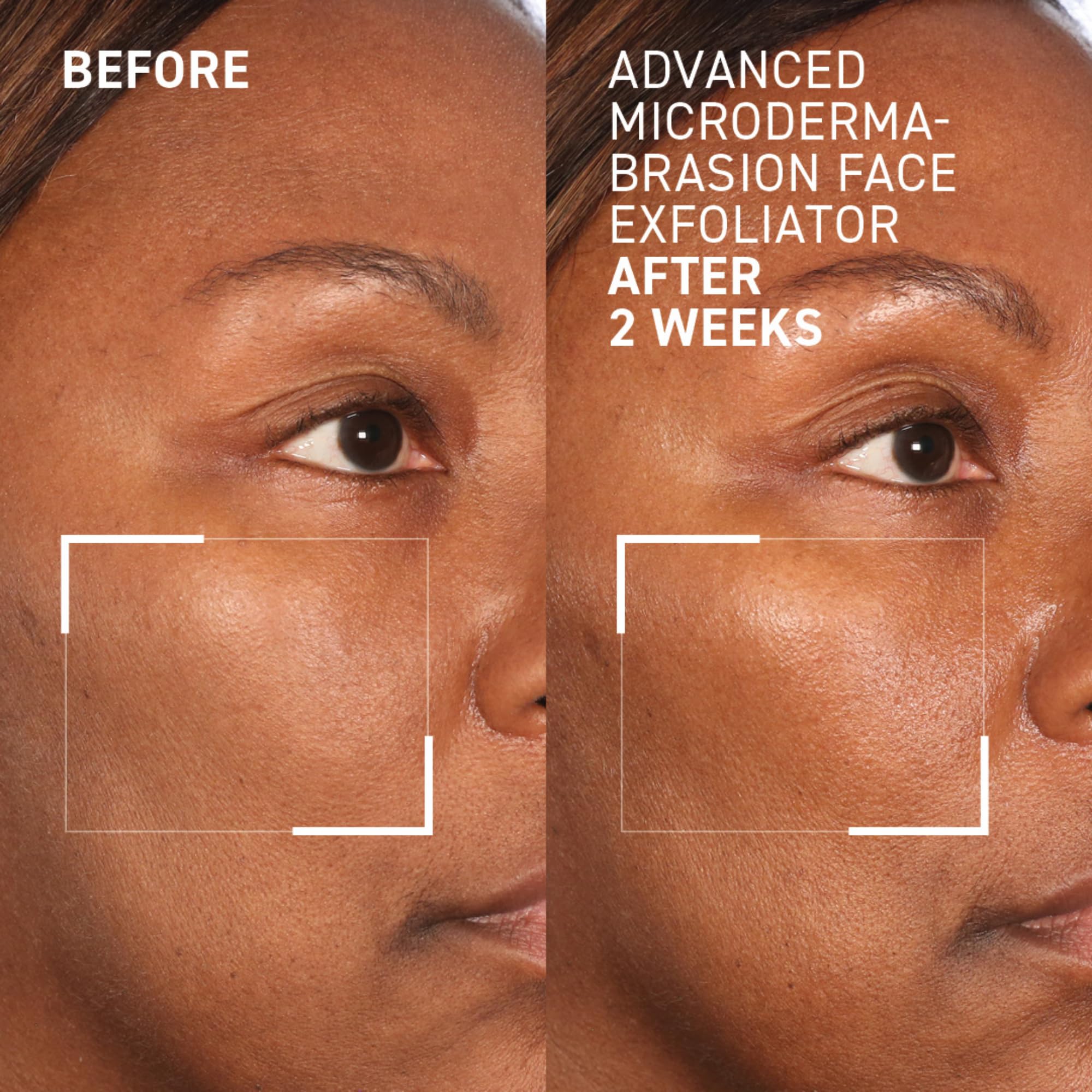 Dr. Brandt Advanced Microdermabrasion Face Exfoliator – Refines Texture & Evens Skin Tone | 2 oz