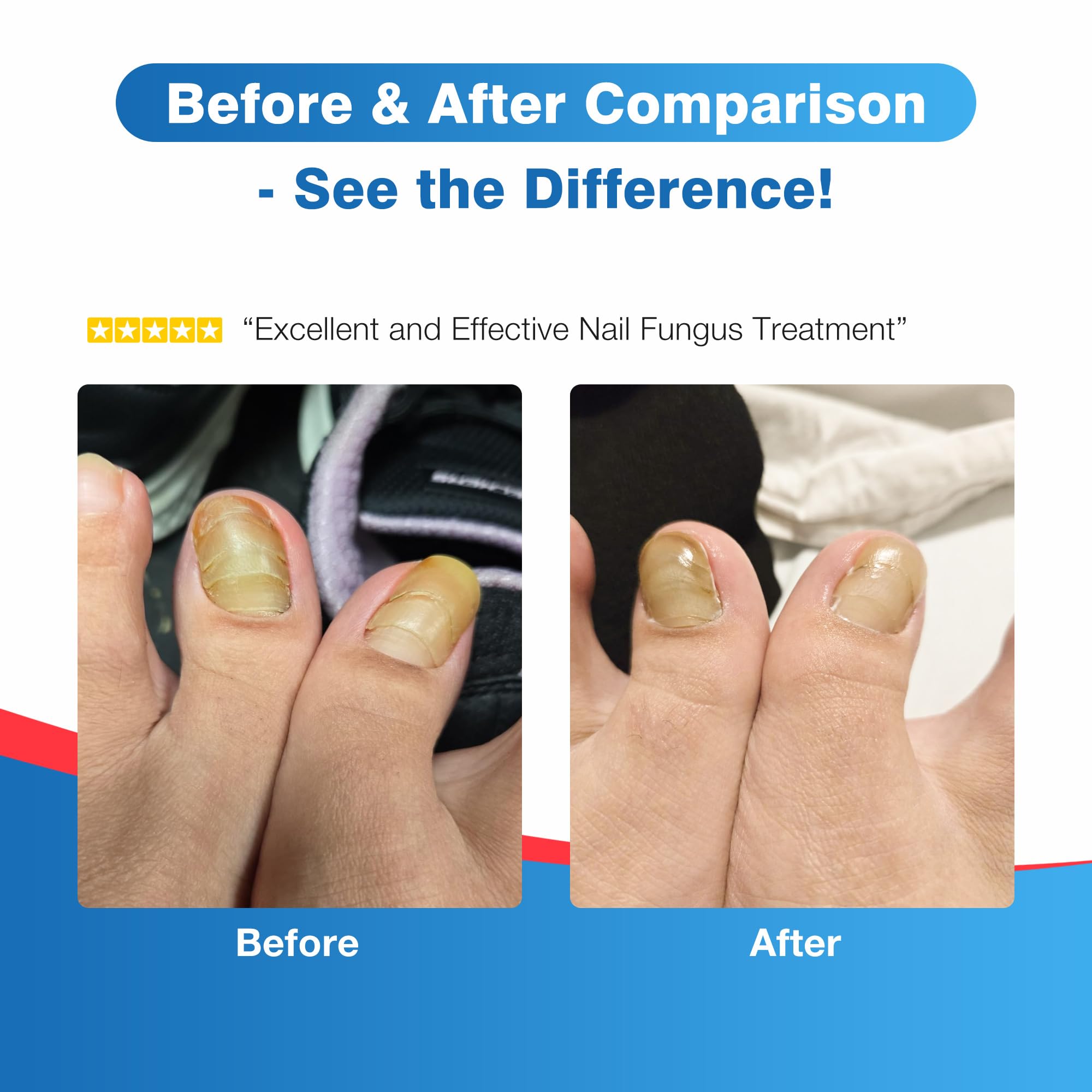 DR.RAPID Toenail Fungus Treatment Pen Extra Strength – 25% Undecylenic Acid & Terbinafine (5ml, 3 Pcs)