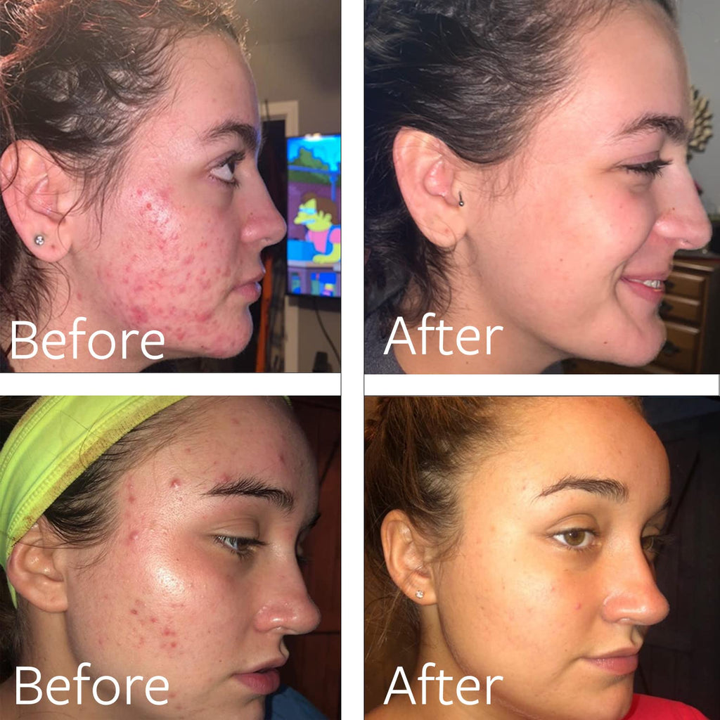Dr Song 10% Benzoyl Peroxide Wash – Acne Face & Body Treatment (8 oz)