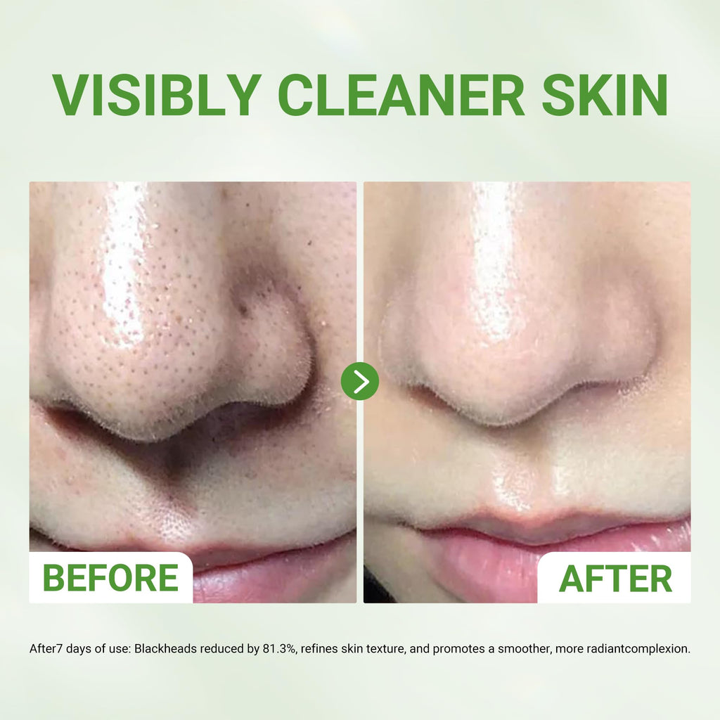 Dr.Leo Amazonian White Clay & Glacier Clay 3X Acid Mask – Deep Clean Pores