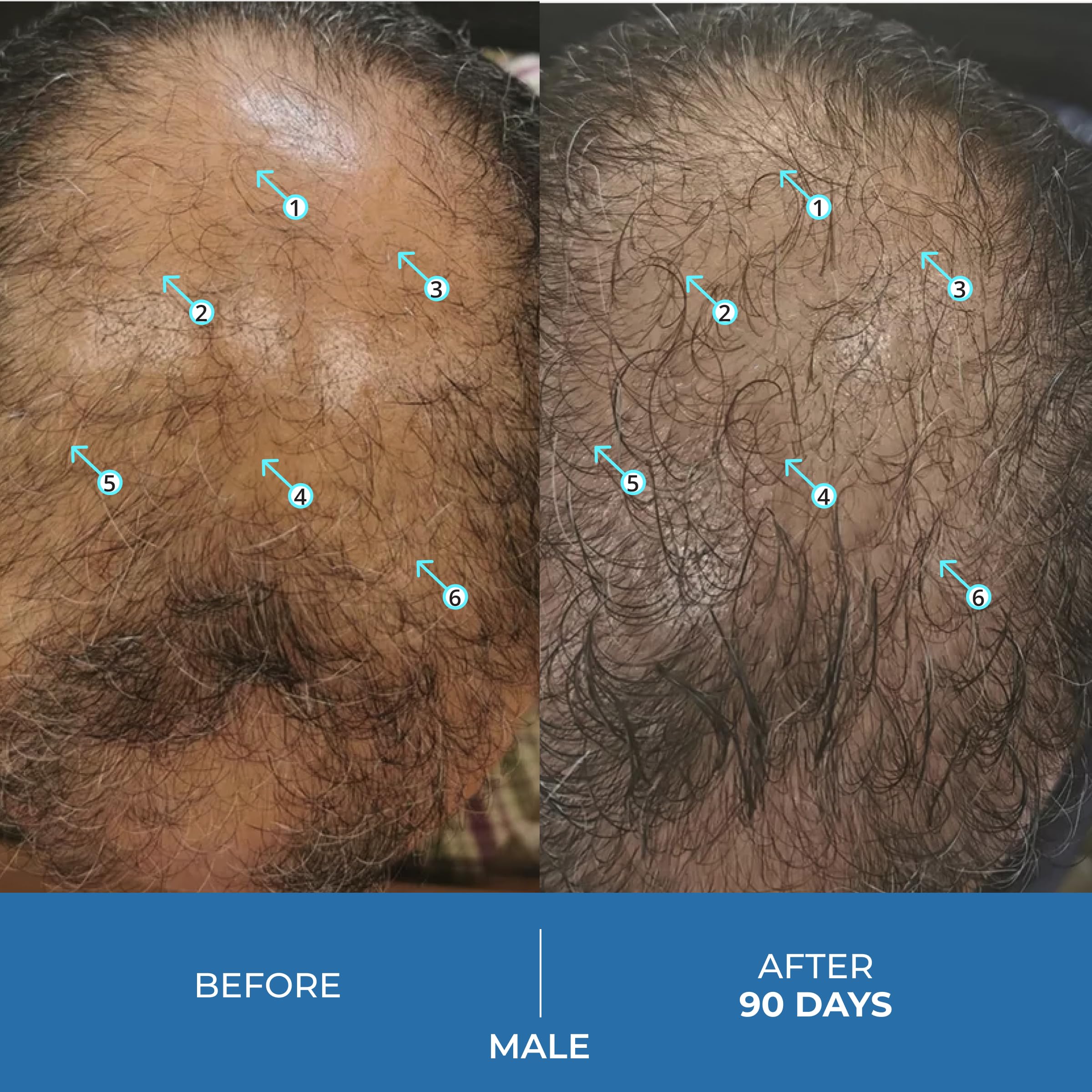 Spectral.UHP 5% Minoxidil Hair Density Serum for Men – Extra Strength, Nanosome Tech, 60mL (3-Pack)