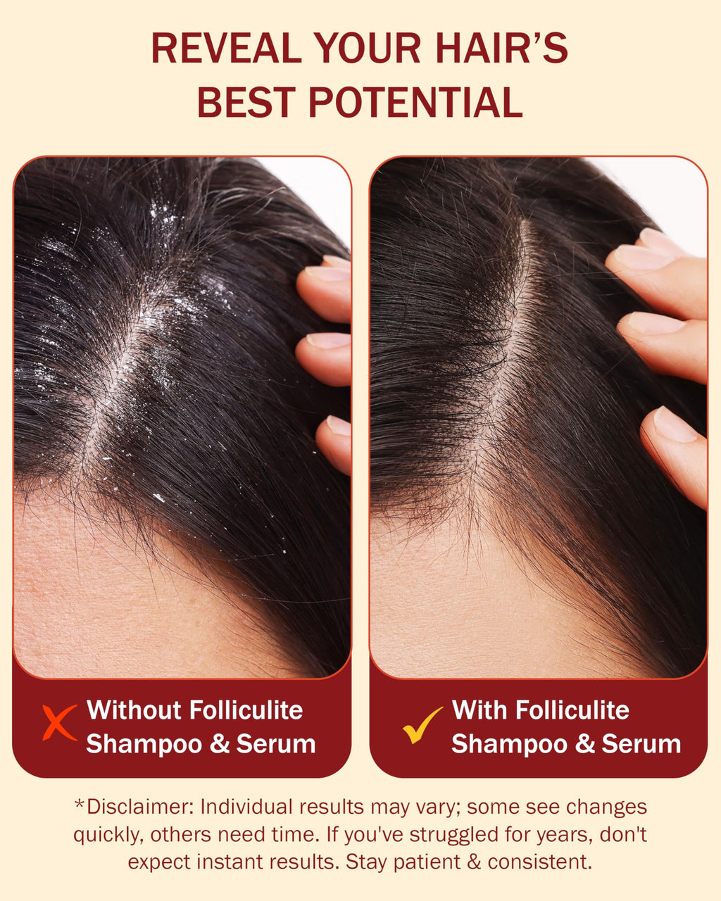 e70 Folliculitis Treatment Shampoo & Serum – 3% BHA, Tea Tree & Chamomile, 8 fl oz