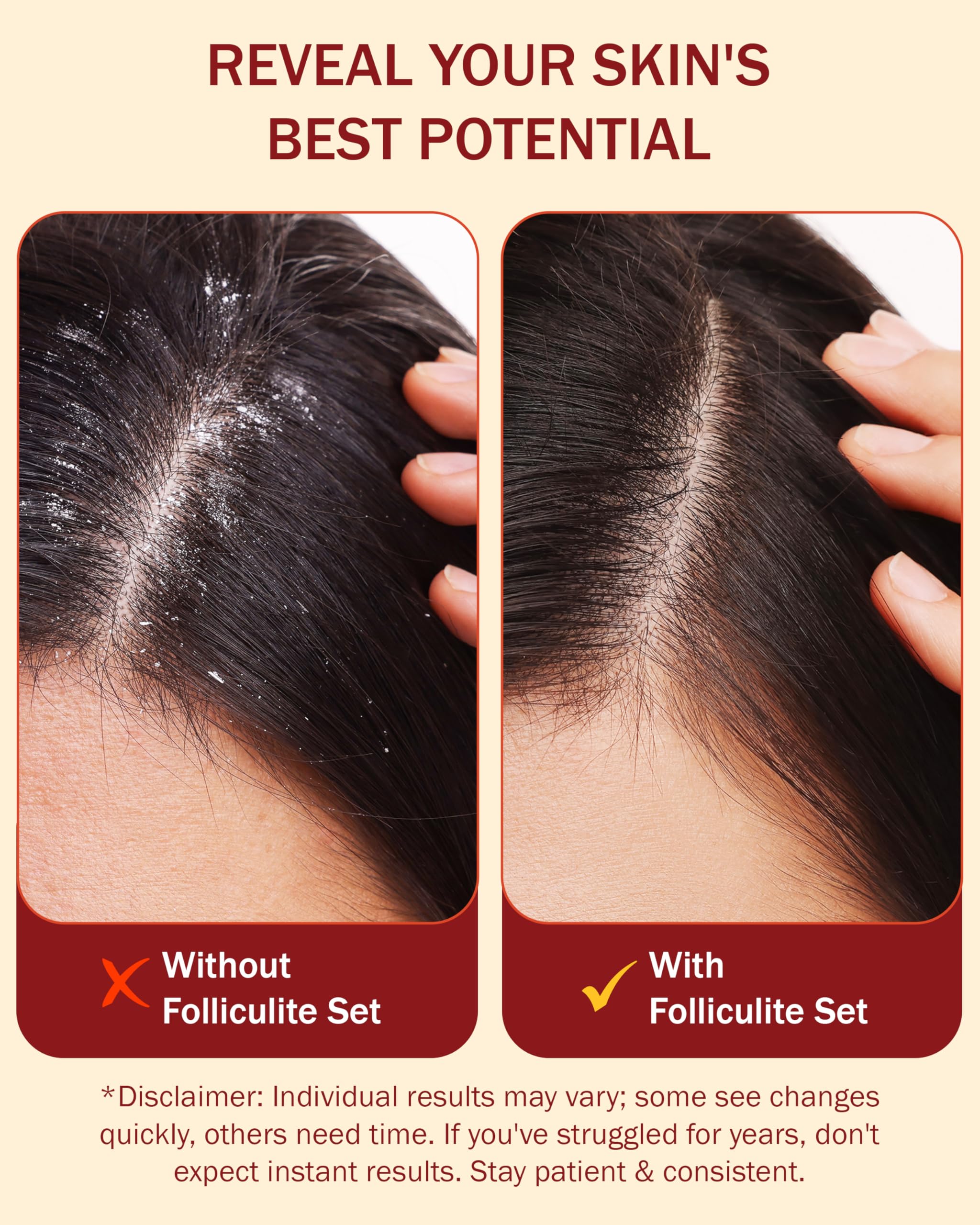 e70 Folliculitis 3-Piece Set: Shampoo, Serum & Body Spray with Salicylic Acid