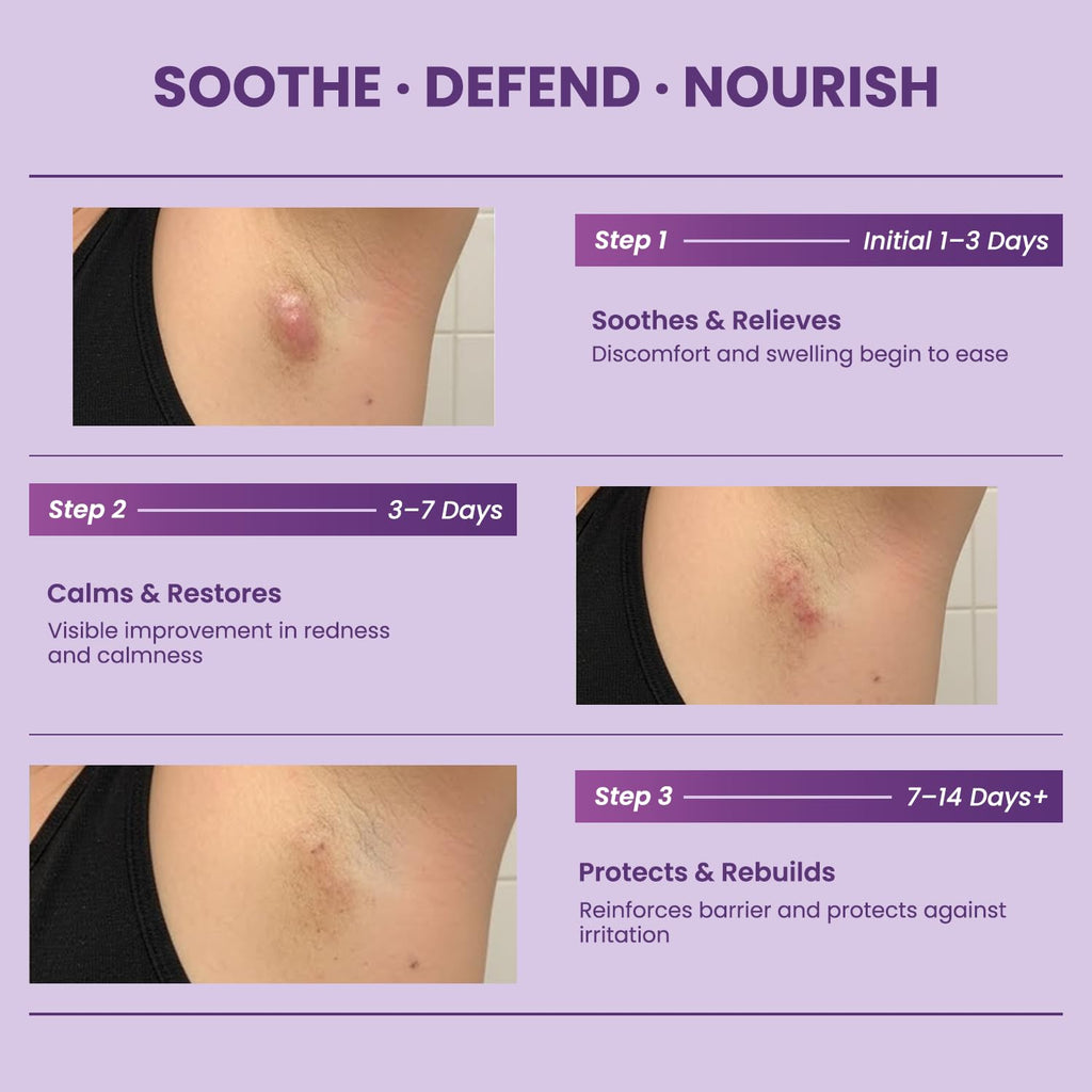 Easment Flare Defense Balm for Hidradenitis Suppurativa – 2 oz | Microsilver BG™ + Zinc Oxide