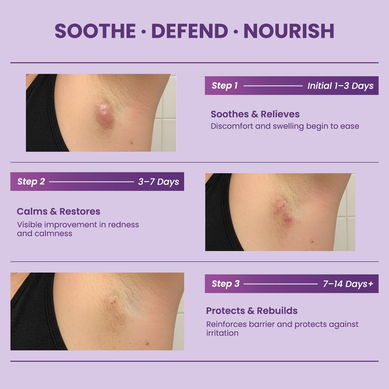 Easment Flare Defense Balm for Hidradenitis Suppurativa – 2 oz | Microsilver BG™ + Zinc Oxide