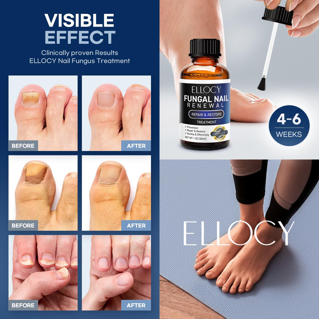 Ellocy Toenail Fungus Treatment Extra Strength – Nail Repair Liquid 30ml