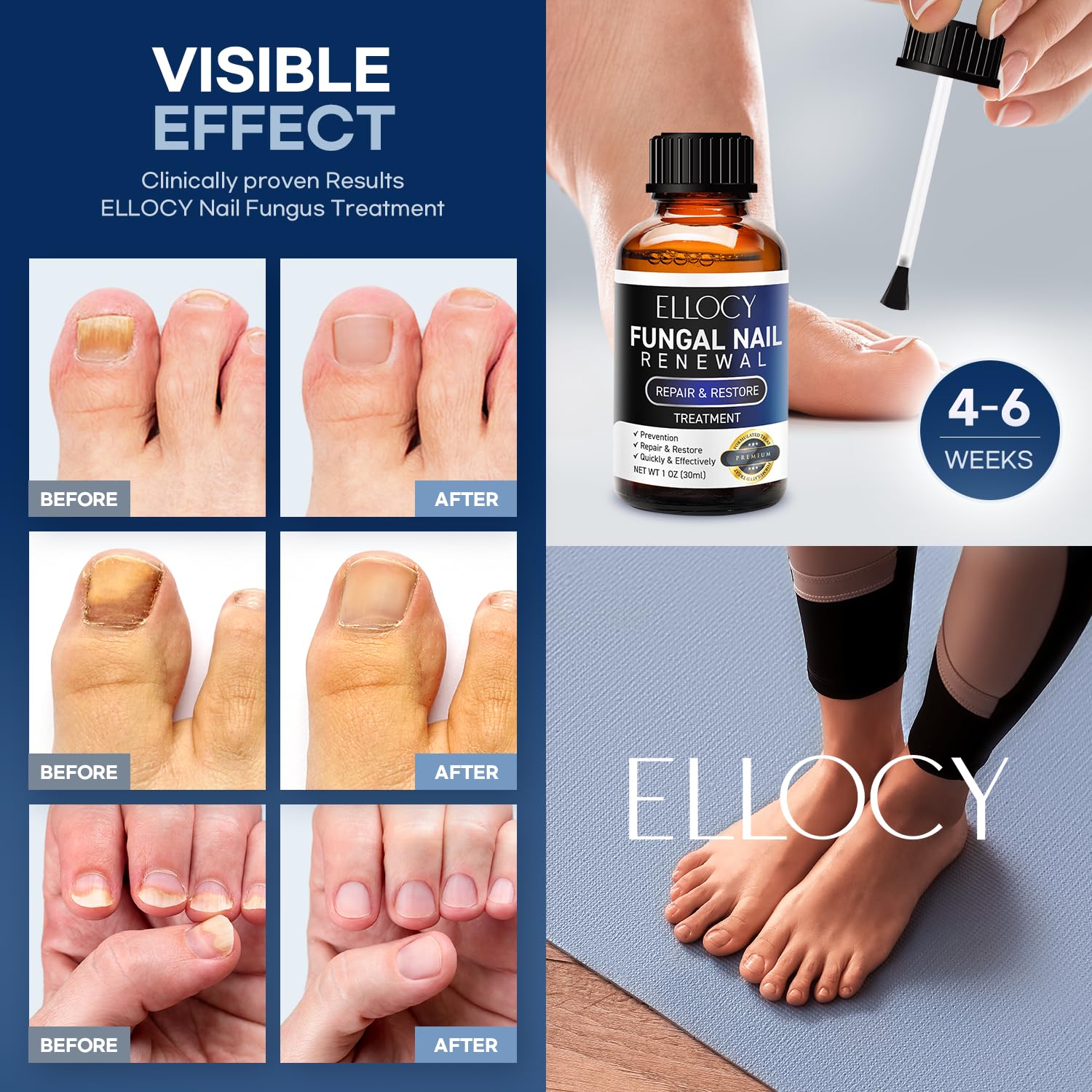 Ellocy Toenail Fungus Treatment Extra Strength – Nail Repair Liquid 30ml