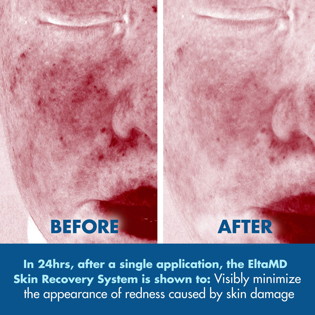 EltaMD Skin Recovery System – 3-Piece Toner, Serum & Light Moisturizer Kit