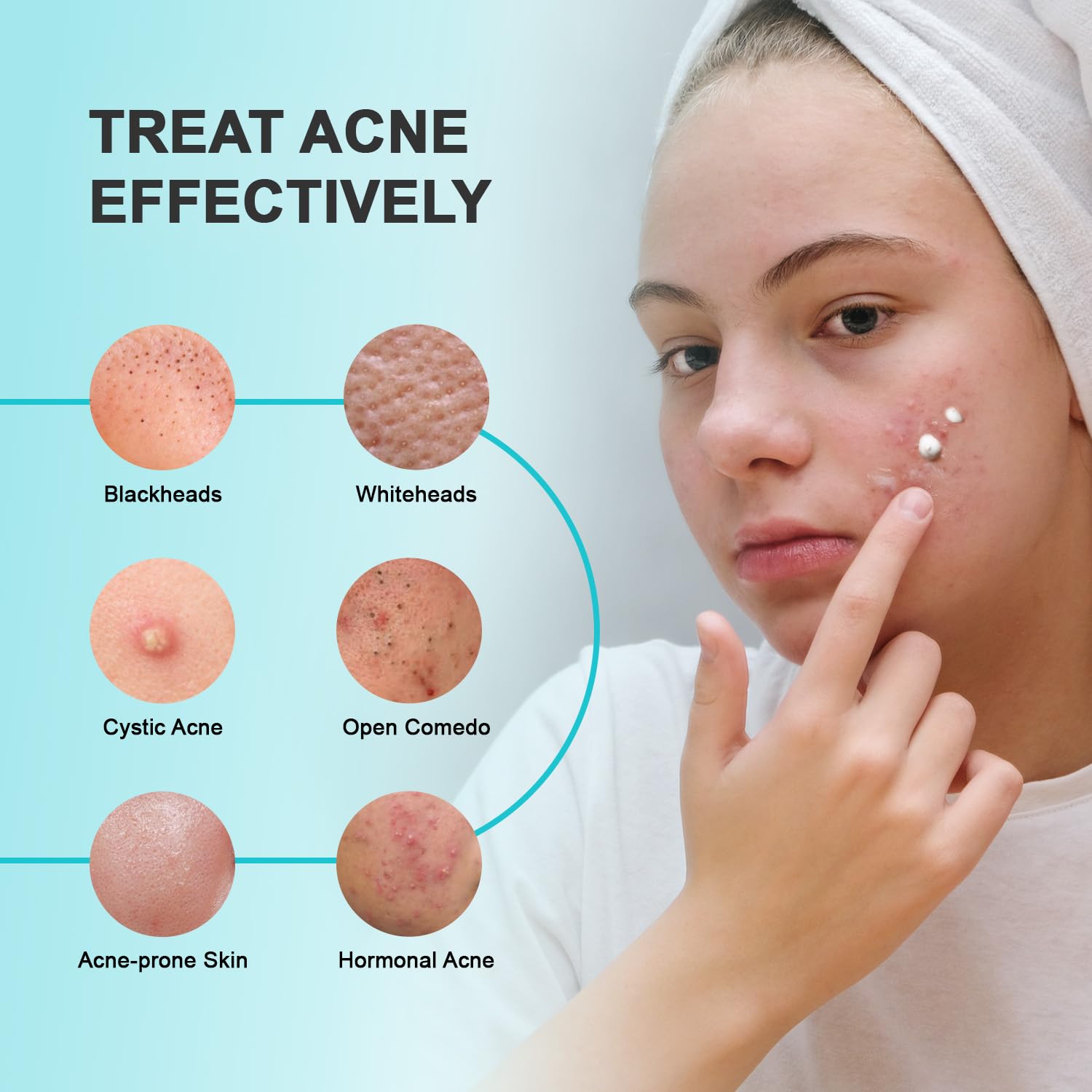 Enaskin Naturals Acne Pimple Spot Treatment Cream – 2% Salicylic Acid for Cystic Breakouts on Face & Back (1.8 oz)