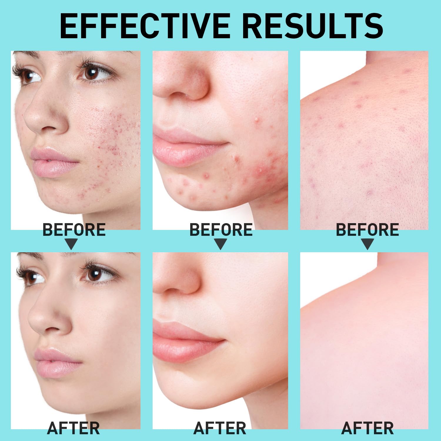 Enaskin Naturals Salicylic Acid Acne Spot Treatment - 2% SA for Cystic & Hormonal Acne | Face, Body & Back, 1.8 oz