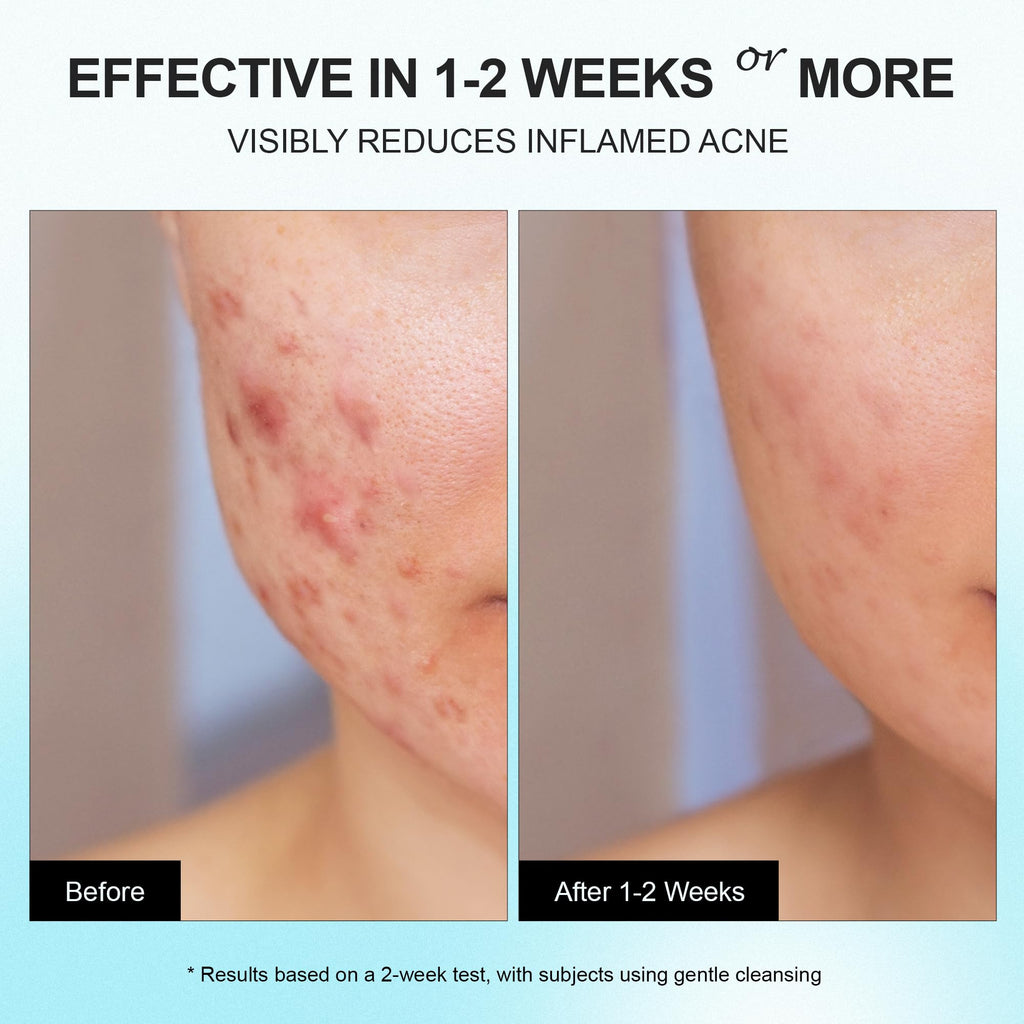 Enaskin Naturals Acne Pimple Spot Treatment Cream – 2% Salicylic Acid for Cystic Breakouts on Face & Back (1.8 oz)