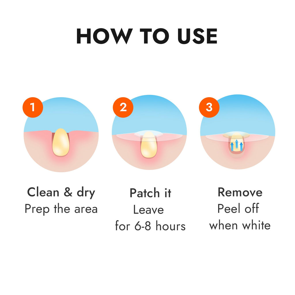 Epielle Over-Zit Acne Clear Patches – 138 Count Hydrocolloid Acne Pimple Patches