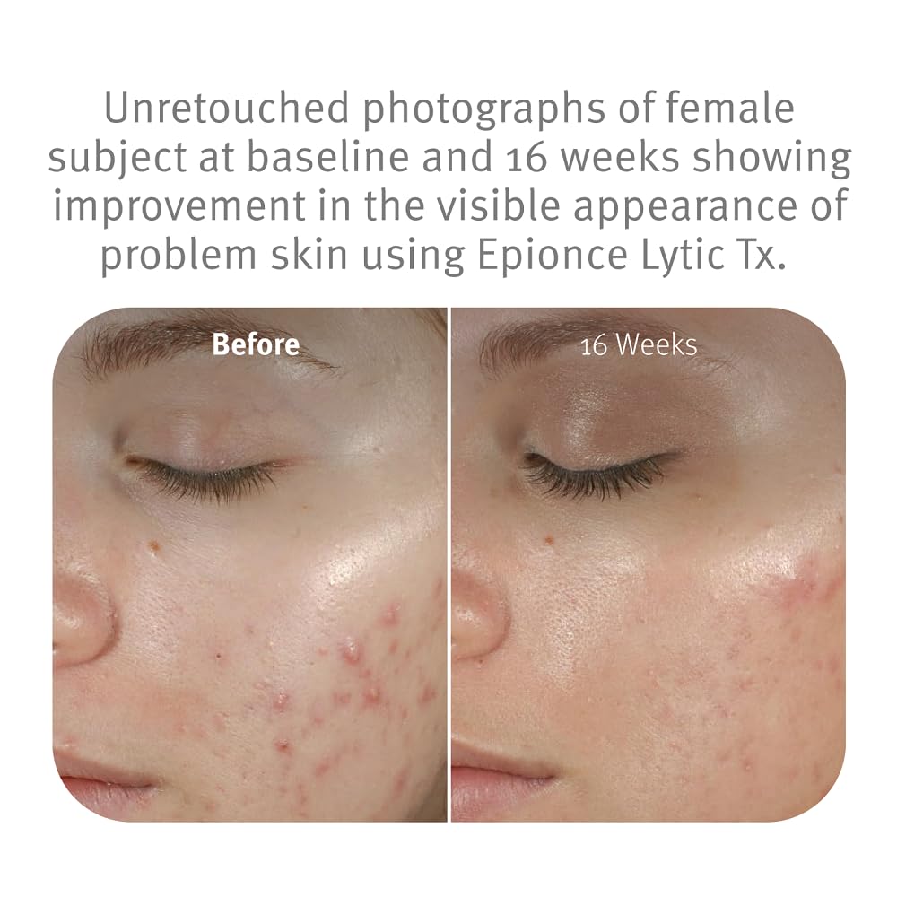 Epionce Lytic Tx – Moderate-Strength Pore-Cleansing Treatment for Combination to Oily Skin