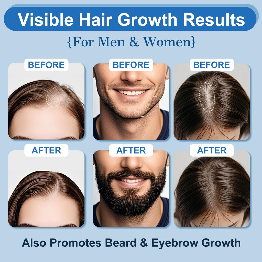 ERYLVEKA 5% Minoxidil Foam – Hair & Beard Growth, Biotin, 4-Month Supply