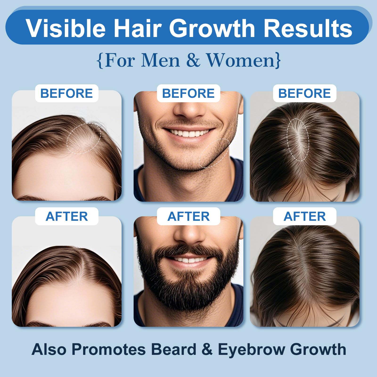 ERYLVEKA 5% Minoxidil Foam – Hair & Beard Growth, Biotin, 4-Month Supply