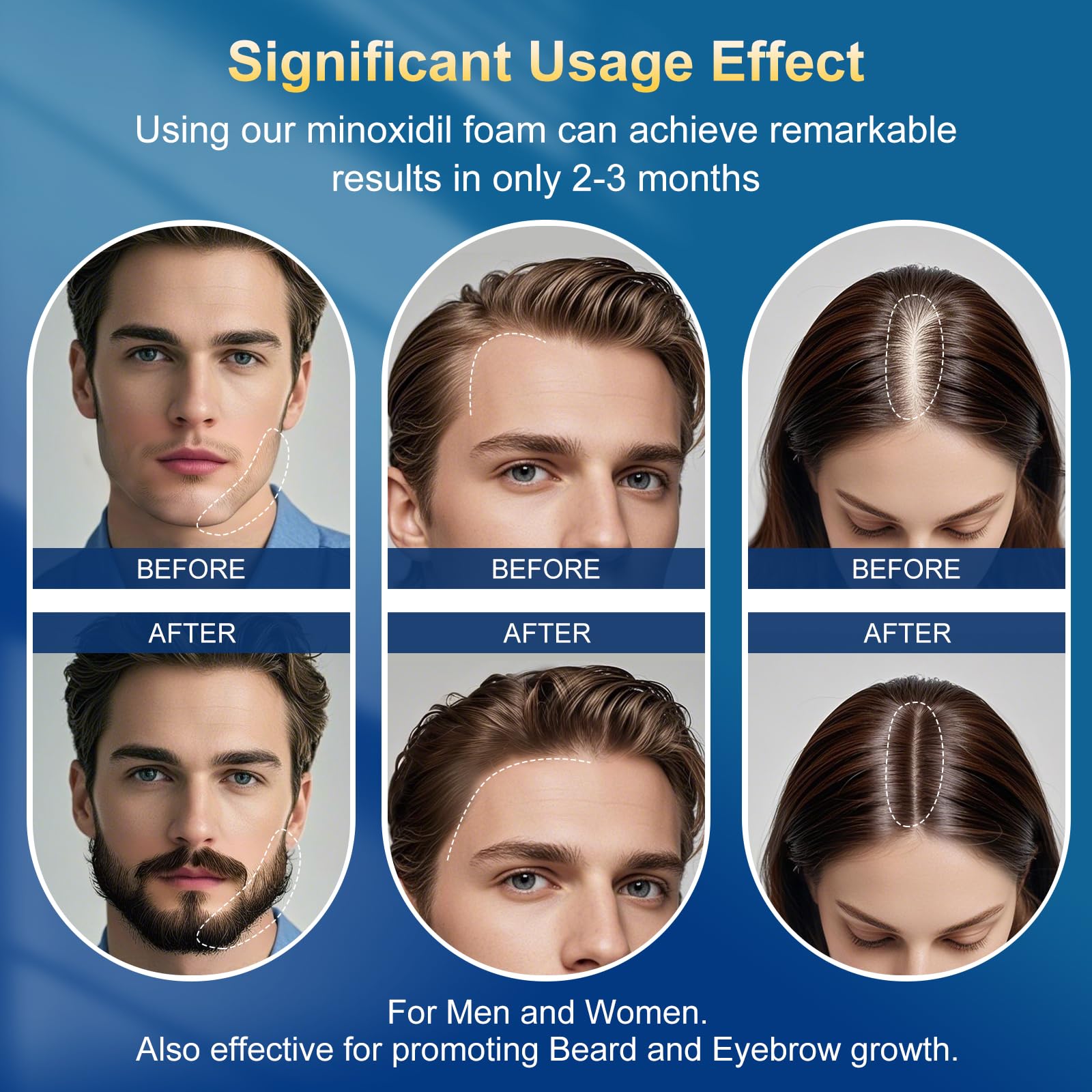 Exdeploy 5% Minoxidil Foam for Men – 5-Pack with Biotin (10.5 oz total)