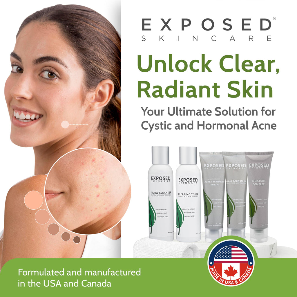 Exposed Skin Care Expanded Acne Treatment Kit – 2.5% Salicylic Acid & 3.5% Benzoyl Peroxide