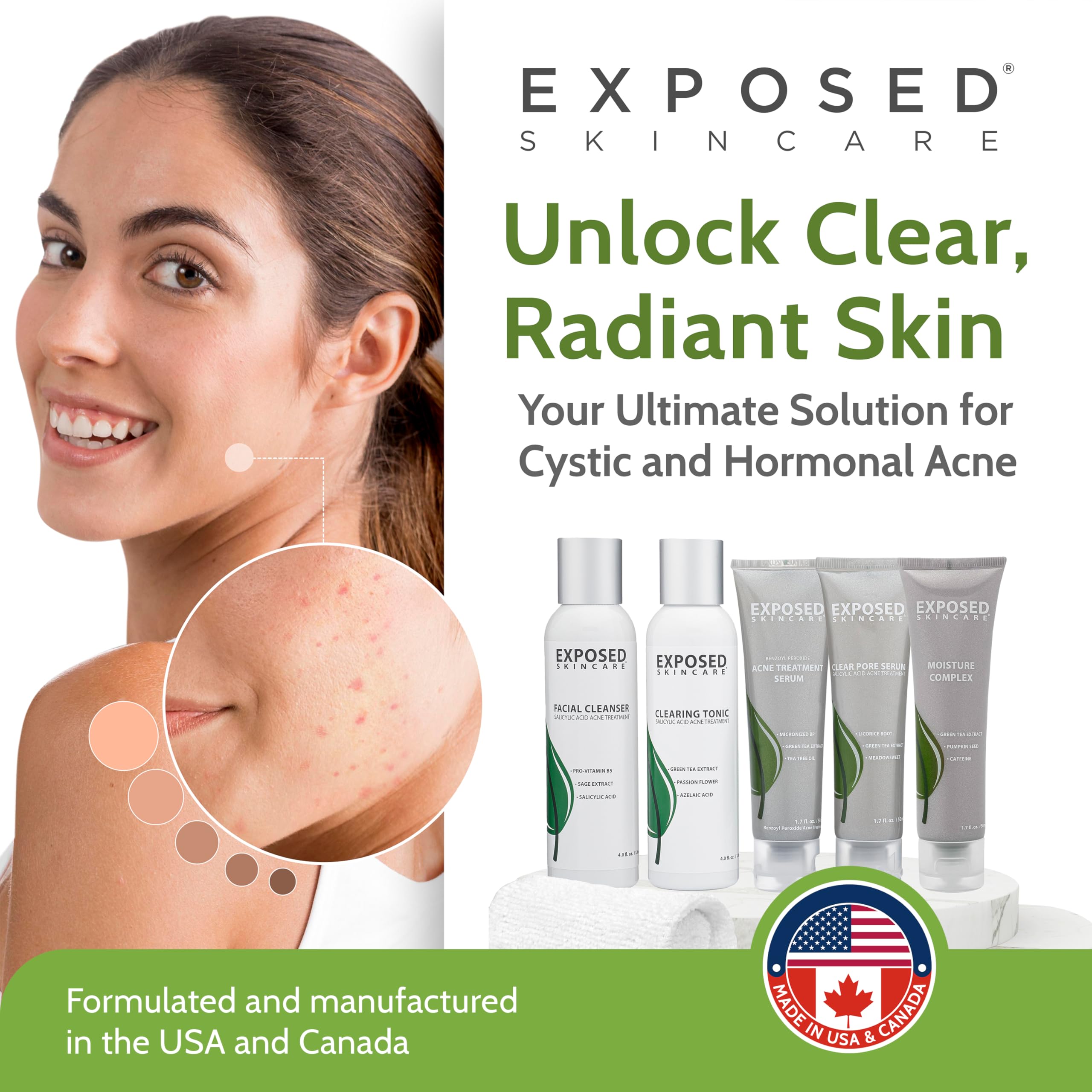 Exposed Skin Care Expanded Acne Treatment Kit – 2.5% Salicylic Acid & 3.5% Benzoyl Peroxide