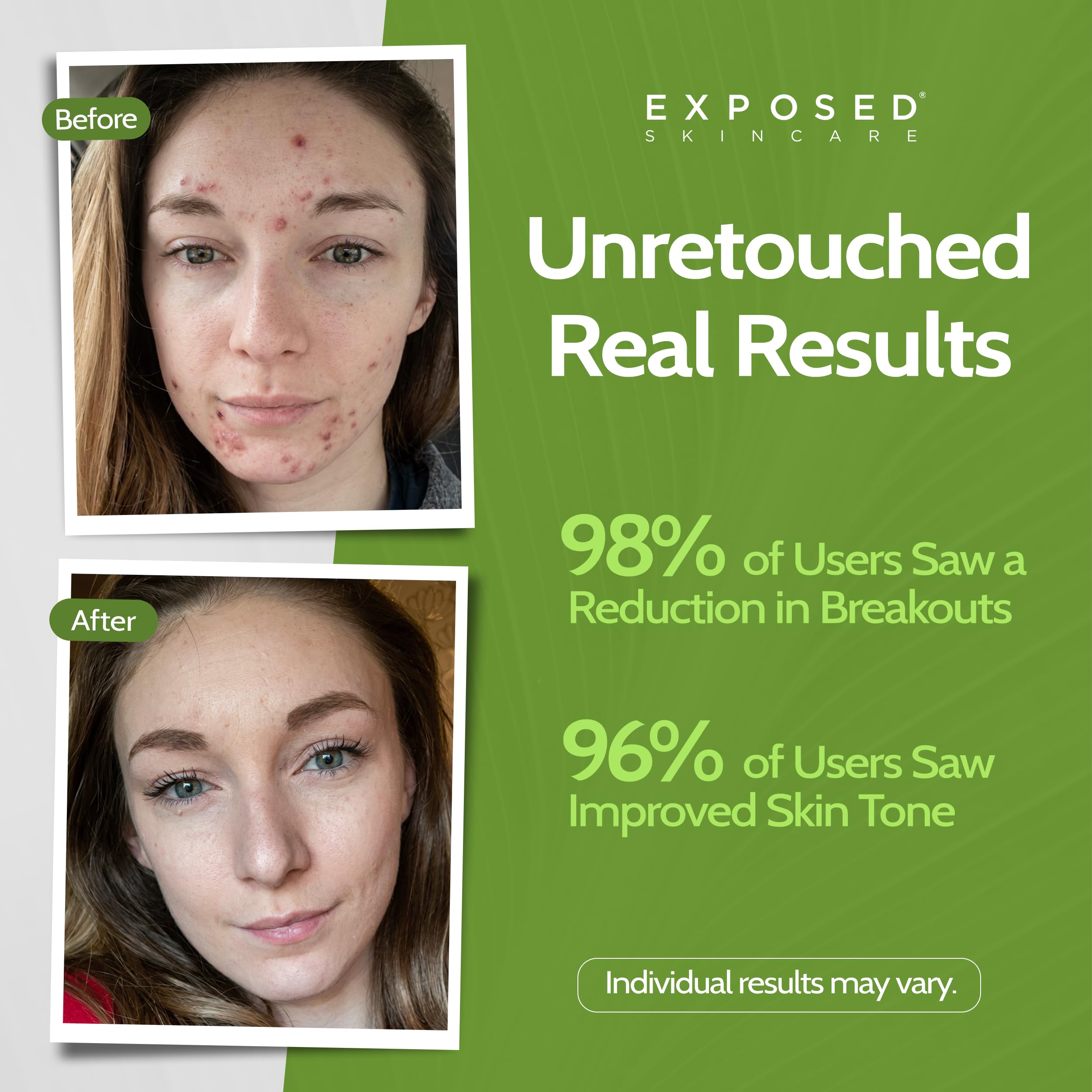 Exposed Skin Care Clearing Tonic – 1% Salicylic Acid & Witch Hazel, Acne Toner