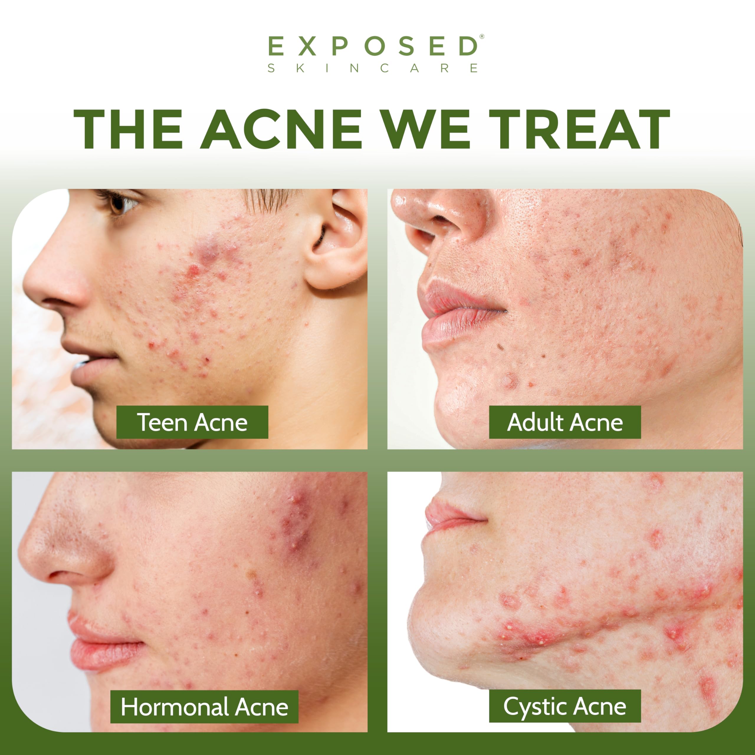 Exposed Skin Care Acne Treatment Kit — 2.5% Salicylic Acid + 3.5% Benzoyl Peroxide, Natural & Cruelty-Free