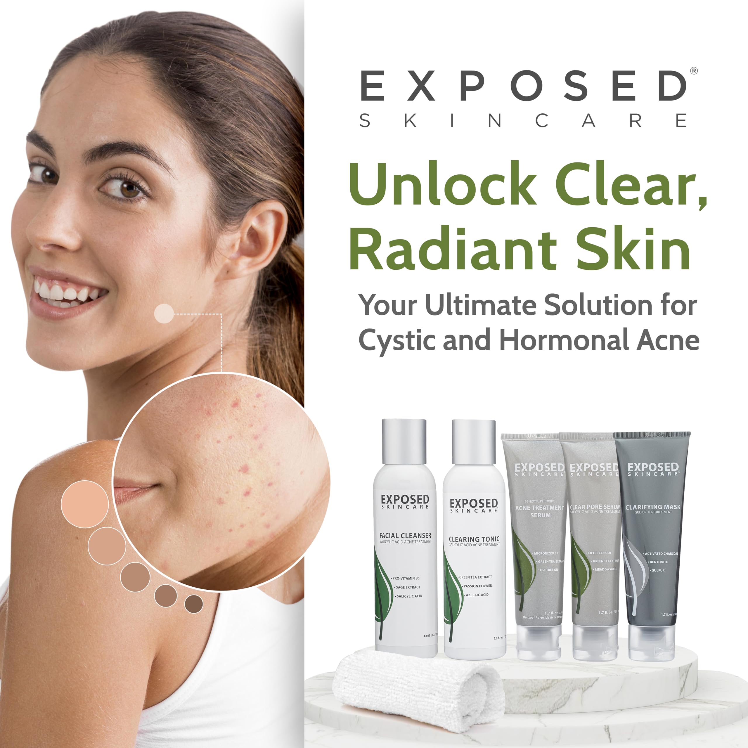 Exposed Skin Care Acne Treatment Kit — 2.5% Salicylic Acid + 3.5% Benzoyl Peroxide, Natural & Cruelty-Free