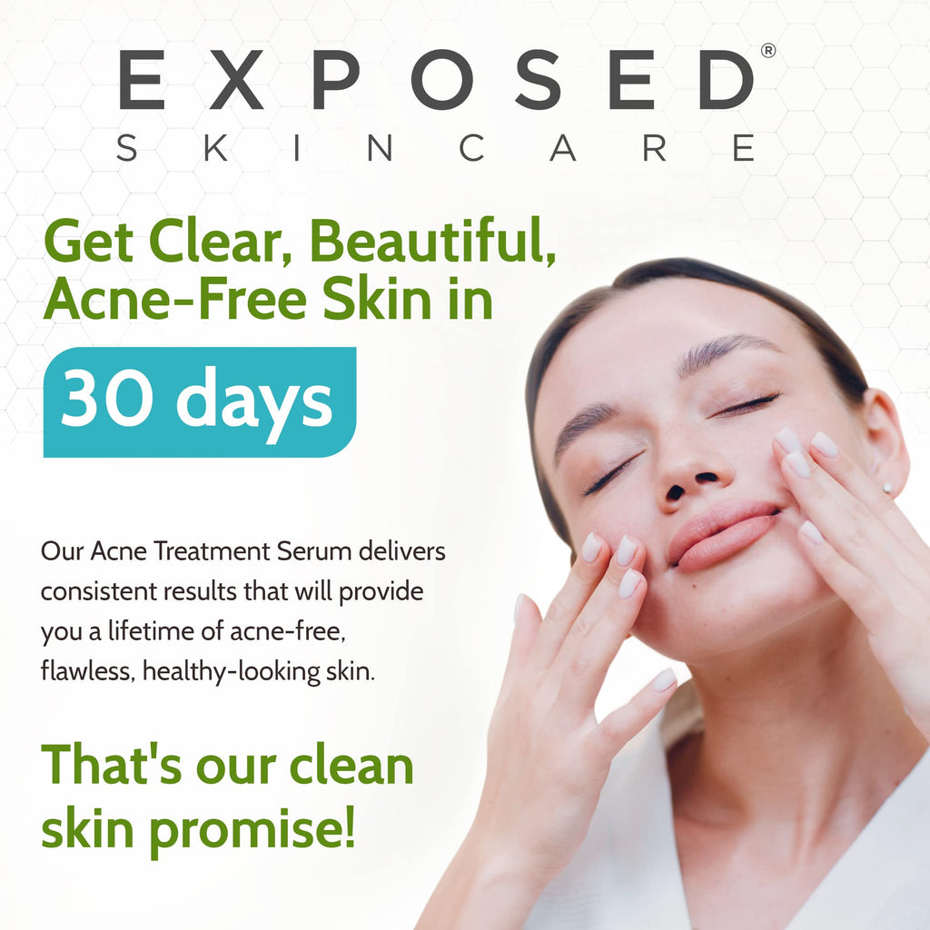 Exposed Skin Care Acne Treatment Serum with 3.5% Benzoyl Peroxide – Lightweight Spot Treatment for Teens, Adults, Hormonal & Cystic Acne – Cruelty Free